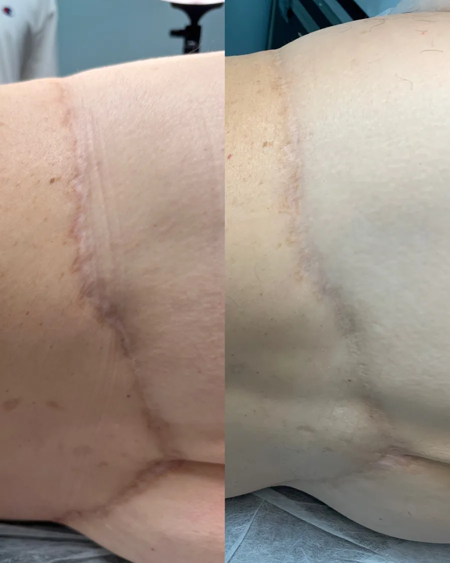 Camuflagem de cicatriz — resultado