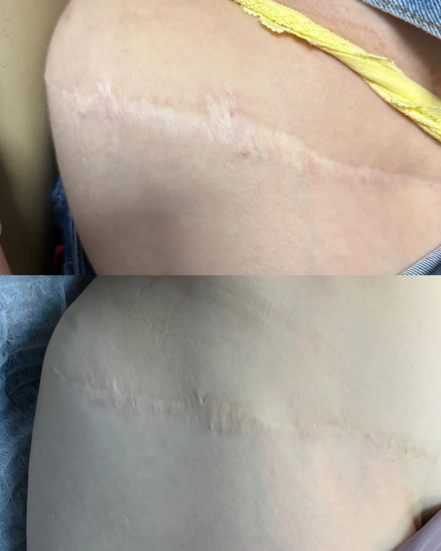 Camuflagem de cicatriz — antes e depois