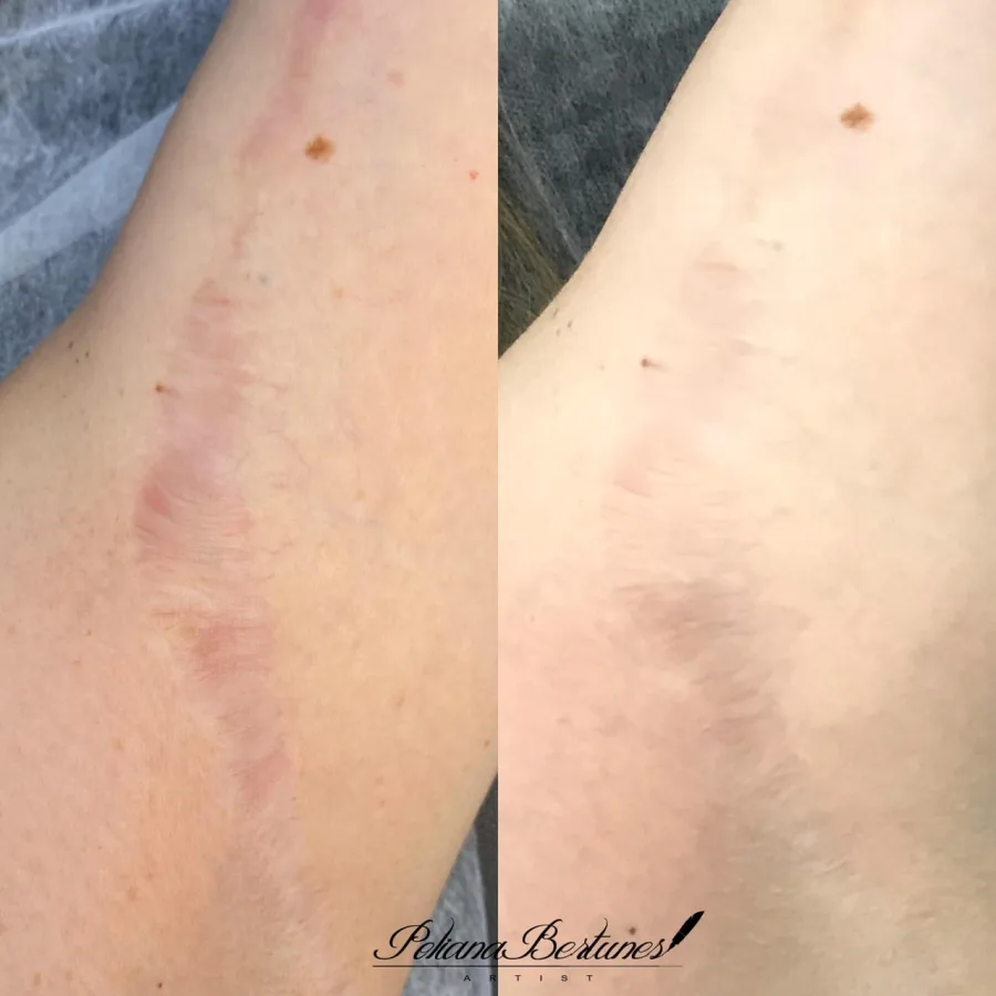 Camuflagem de cicatriz — antes e depois