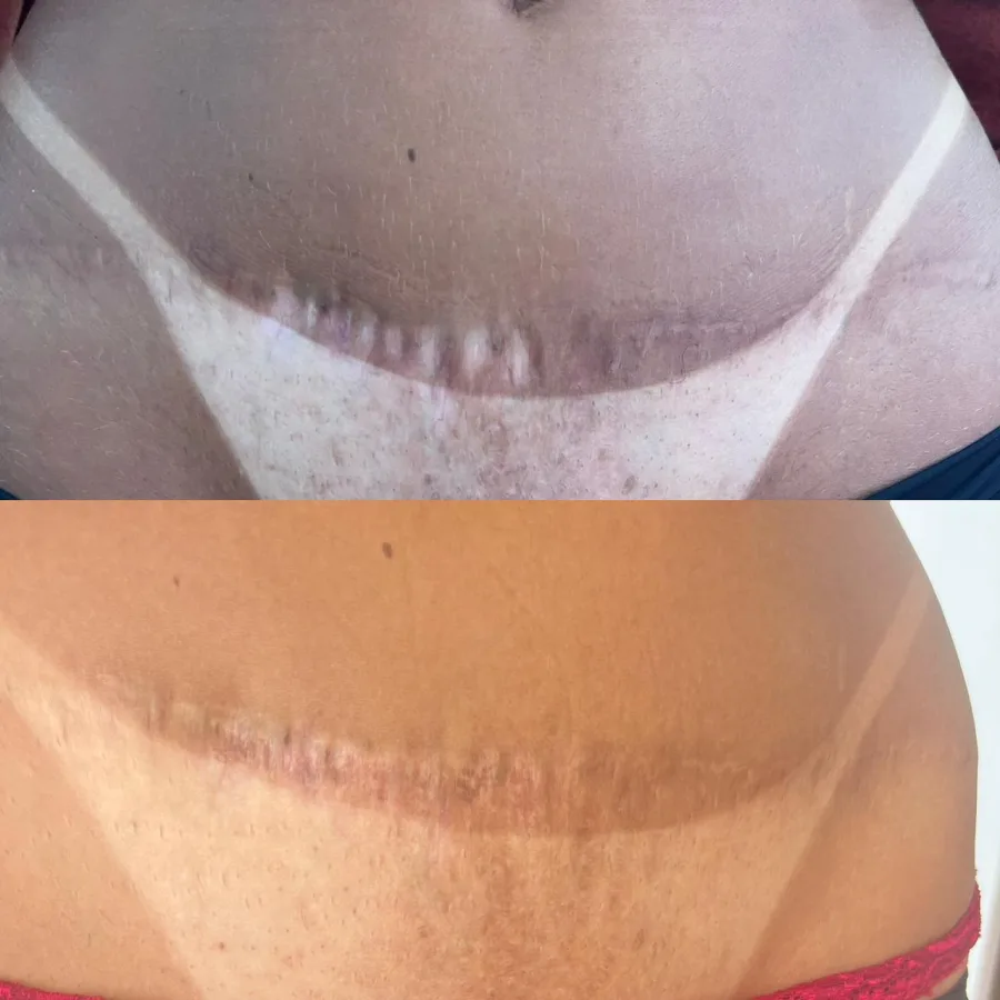 Camuflagem de cicatriz — antes e depois