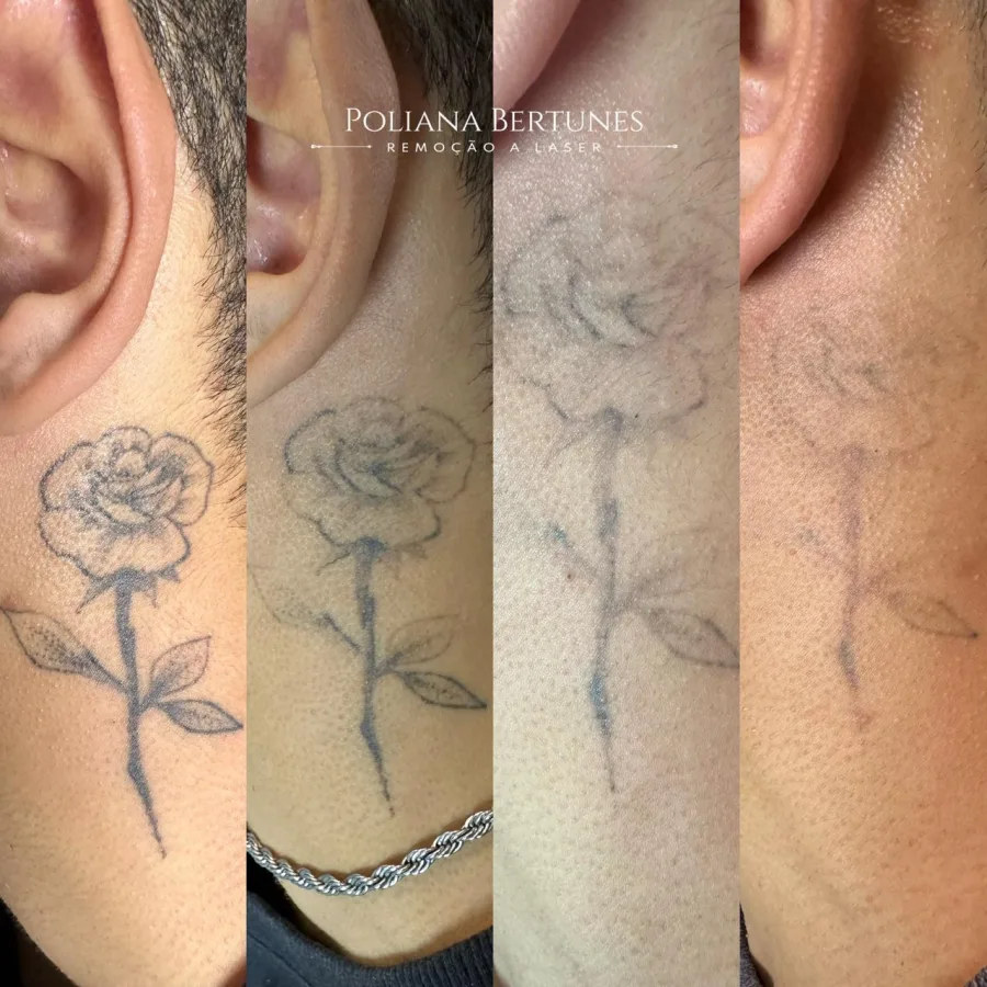 Remoção de tatuagem a laser