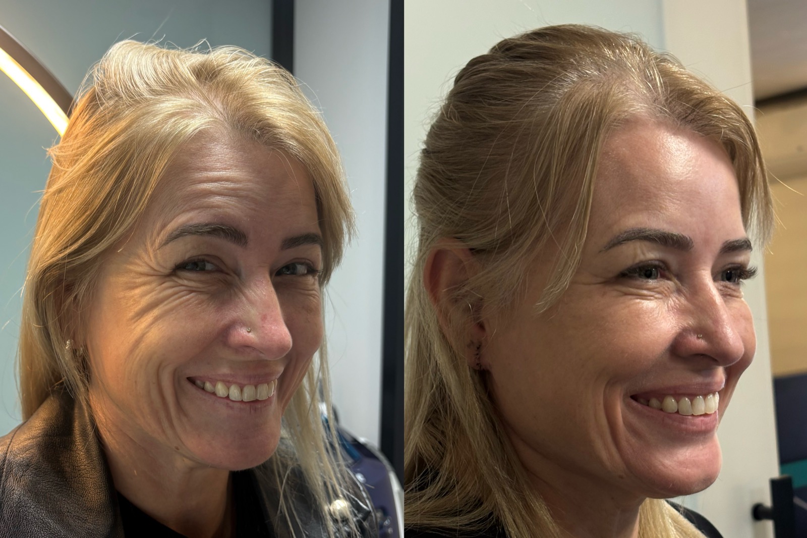 Evolução real do resultado com bioestimulador de colágeno