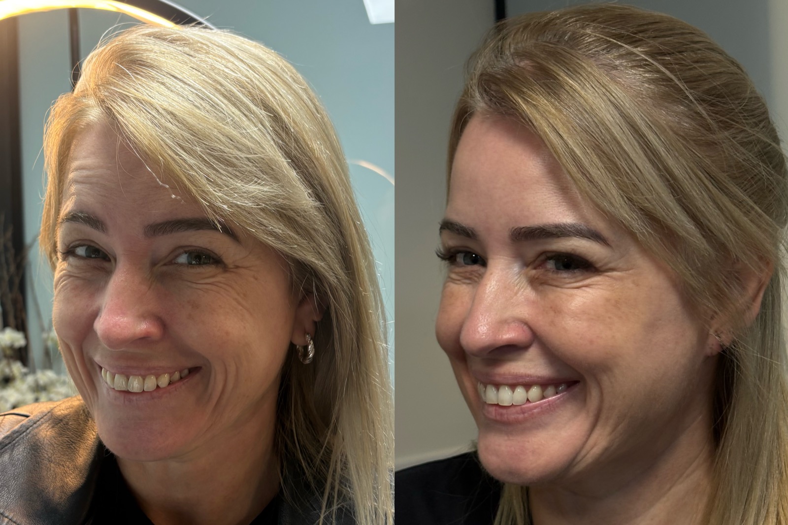 Evolução real do resultado com bioestimulador de colágeno