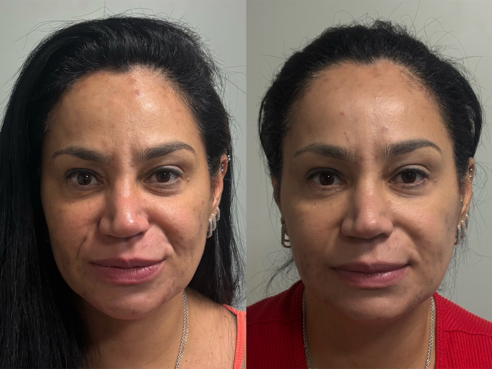 Evolução real do resultado com bioestimulador de colágeno