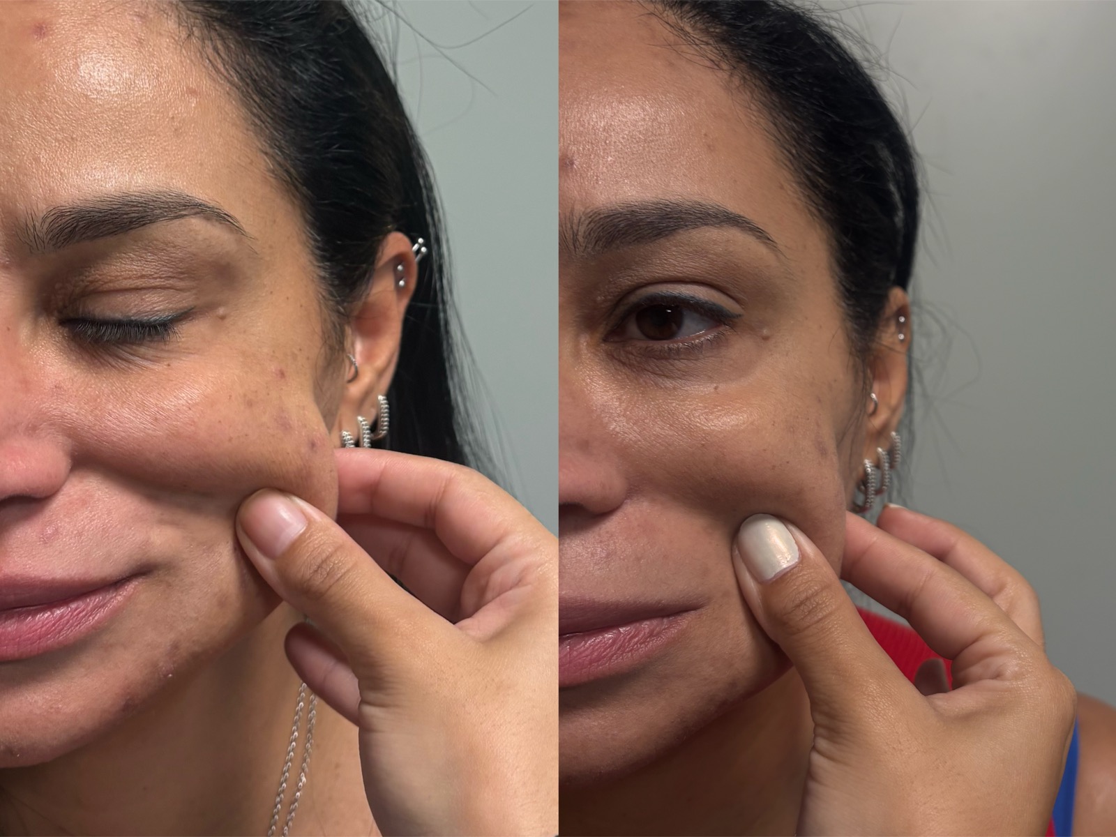 Evolução real do resultado com bioestimulador de colágeno