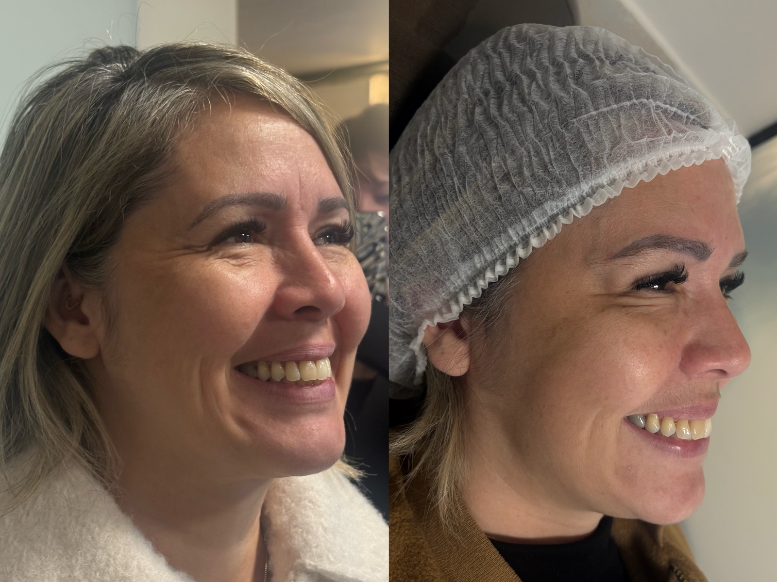 Evolução real do resultado com bioestimulador de colágeno
