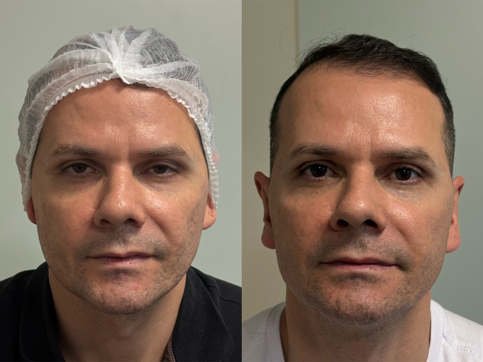 Evolução real do resultado com bioestimulador de colágeno
