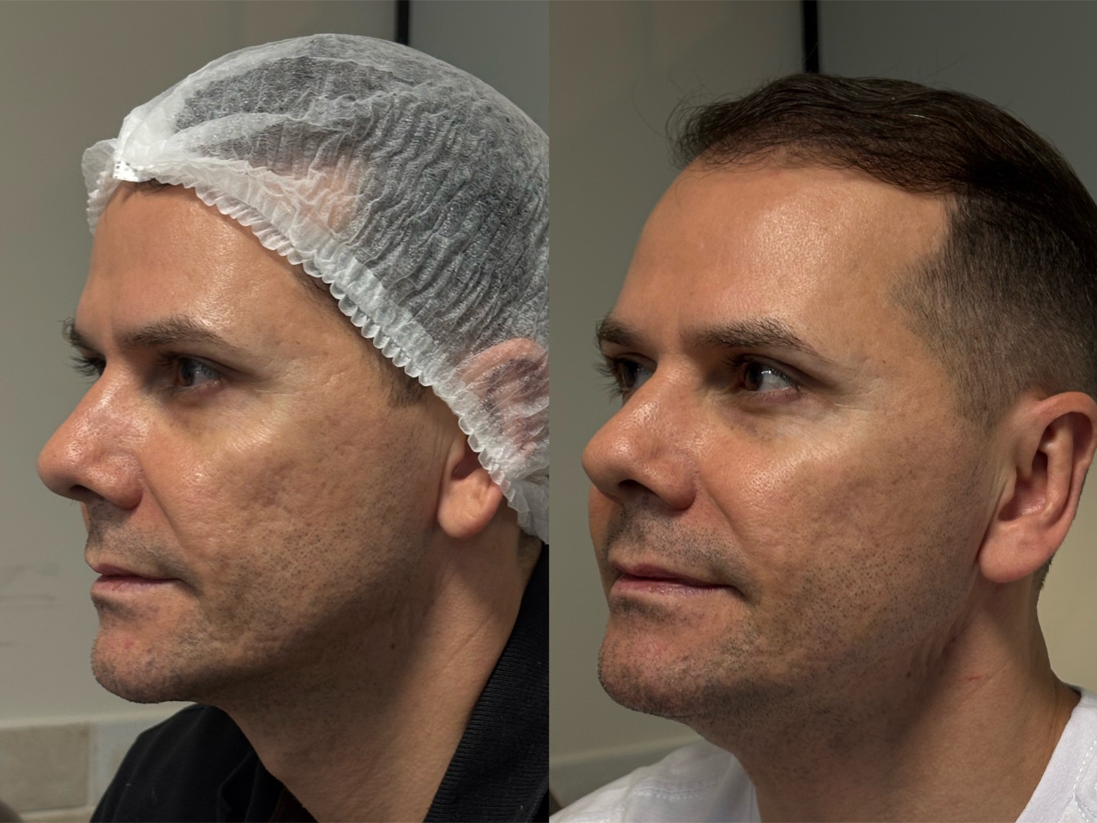 Evolução real do resultado com bioestimulador de colágeno