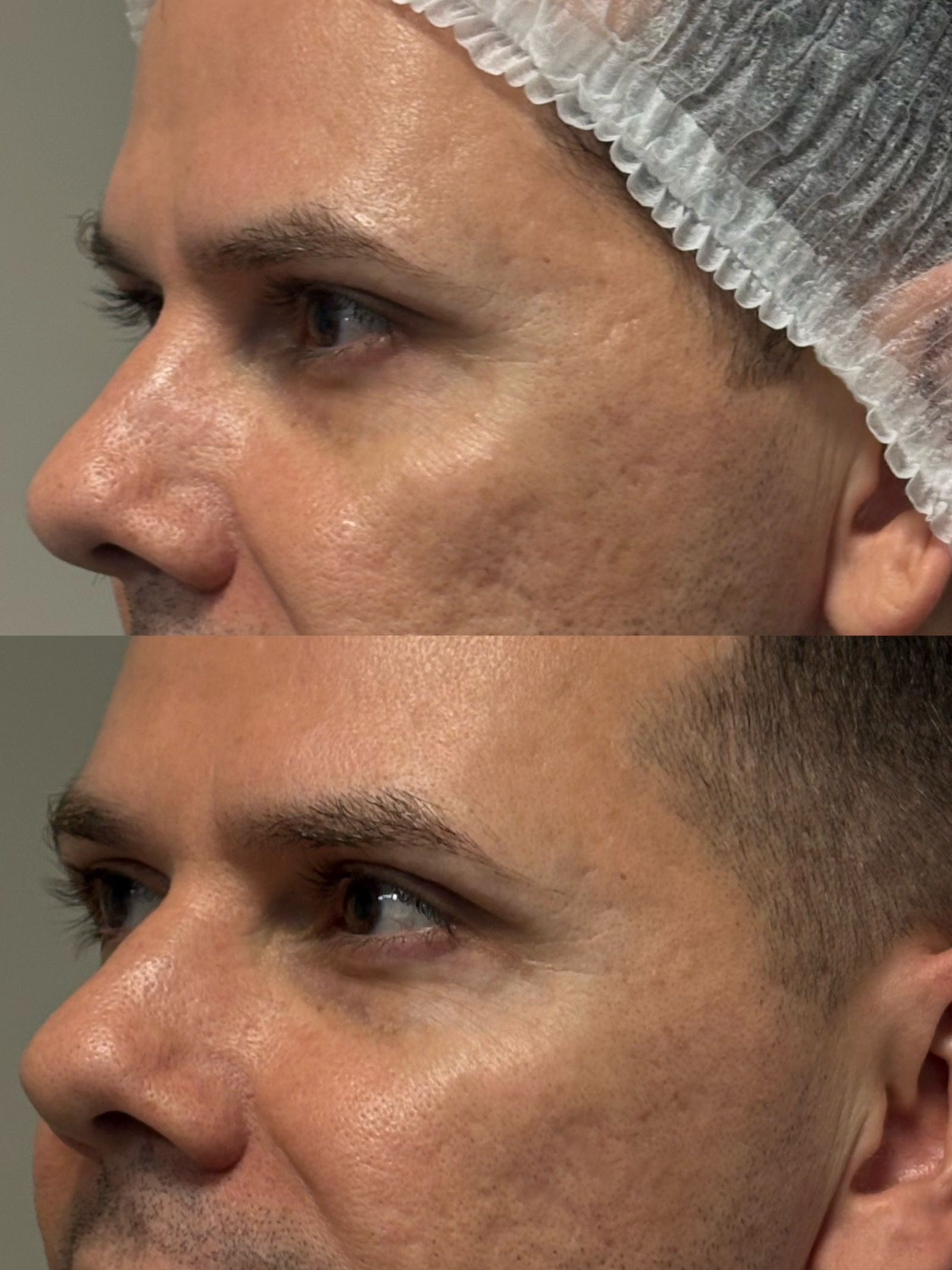 Evolução real do resultado com bioestimulador de colágeno