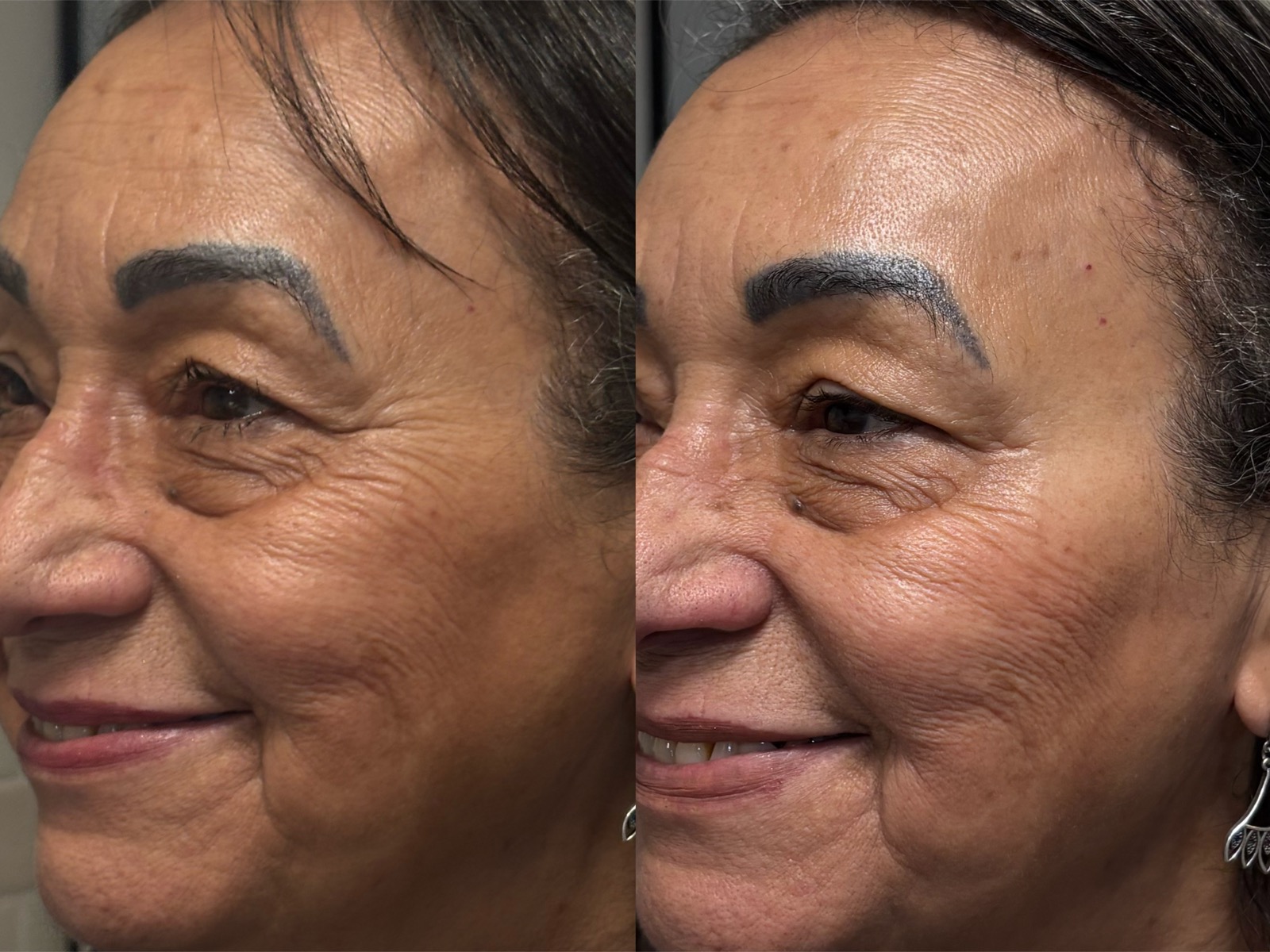 Evolução real do resultado com bioestimulador de colágeno
