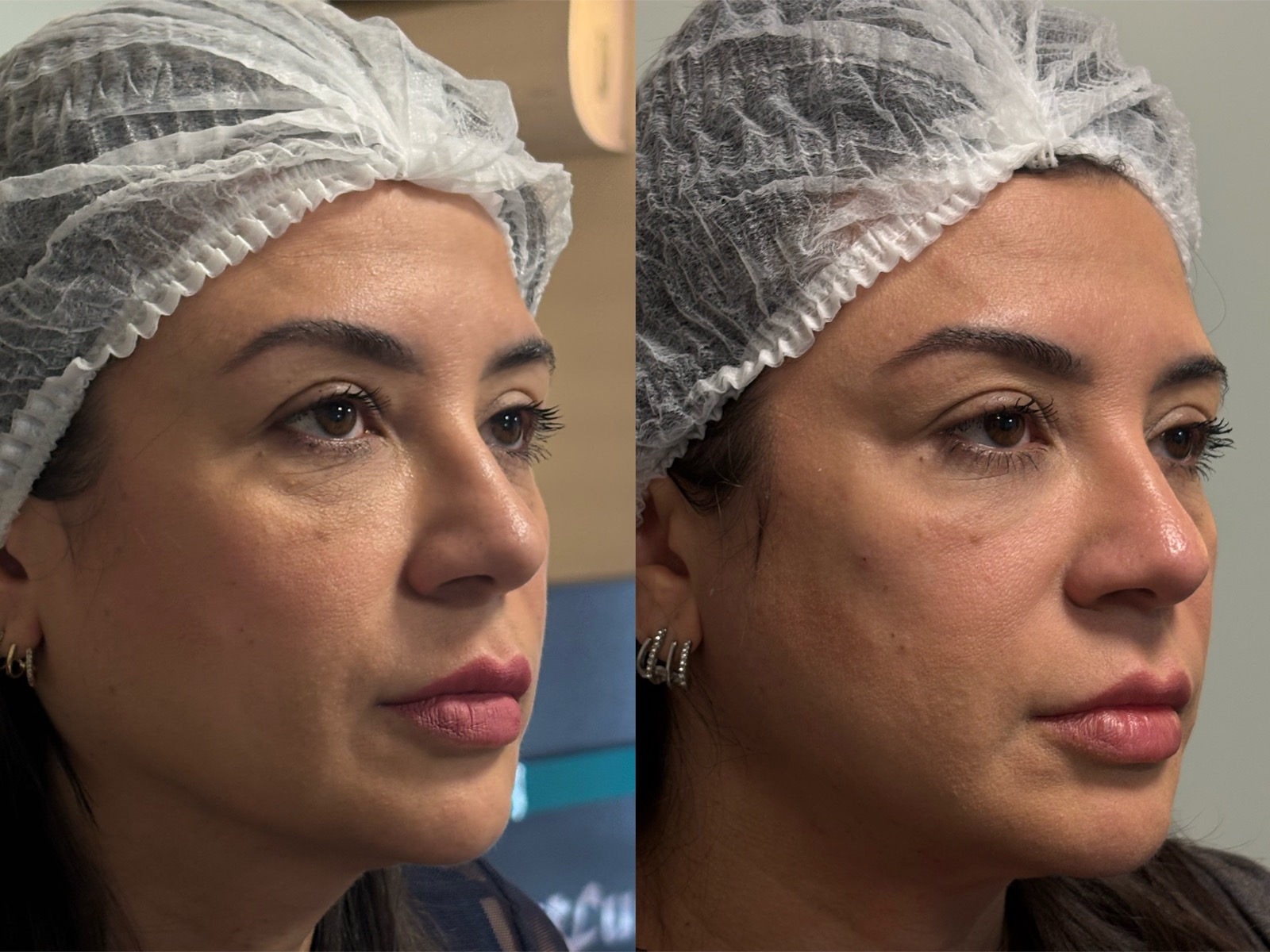 Evolução real do resultado com bioestimulador de colágeno