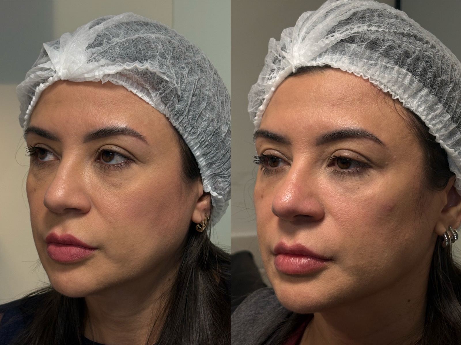 Evolução real do resultado com bioestimulador de colágeno