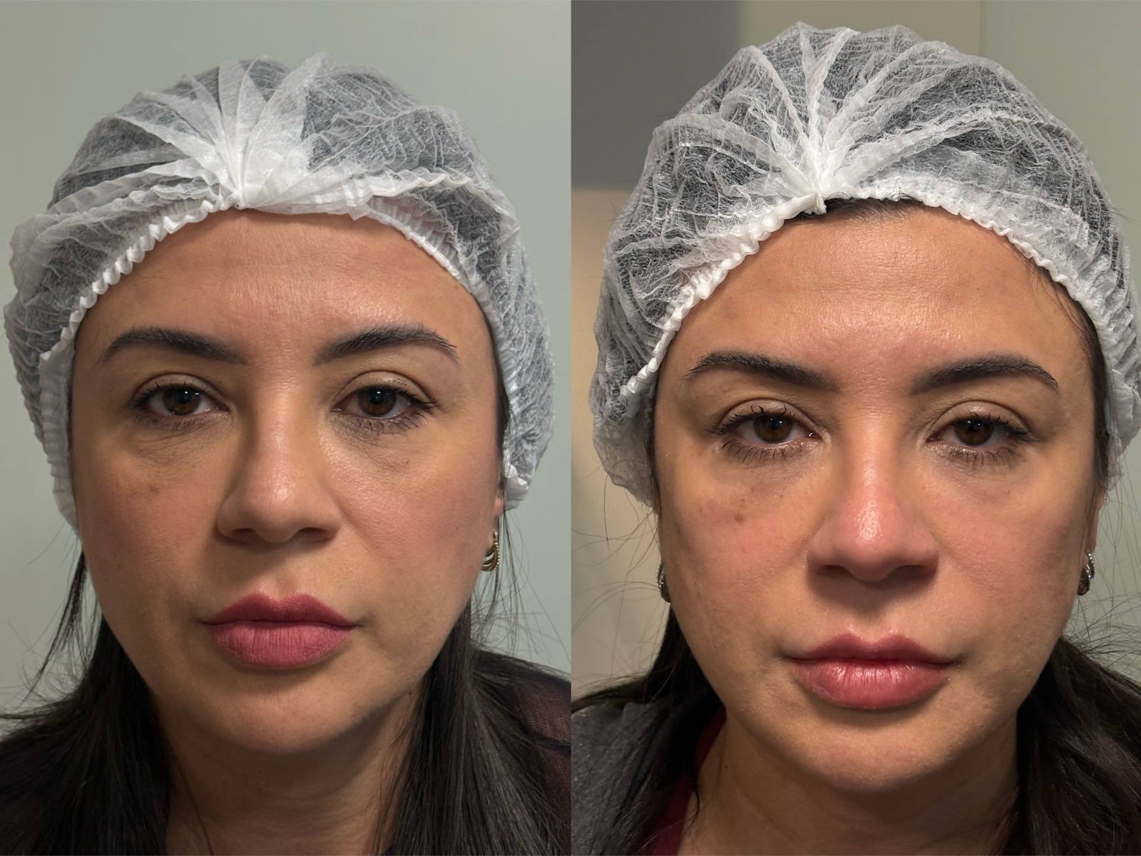 Evolução real do resultado com bioestimulador de colágeno