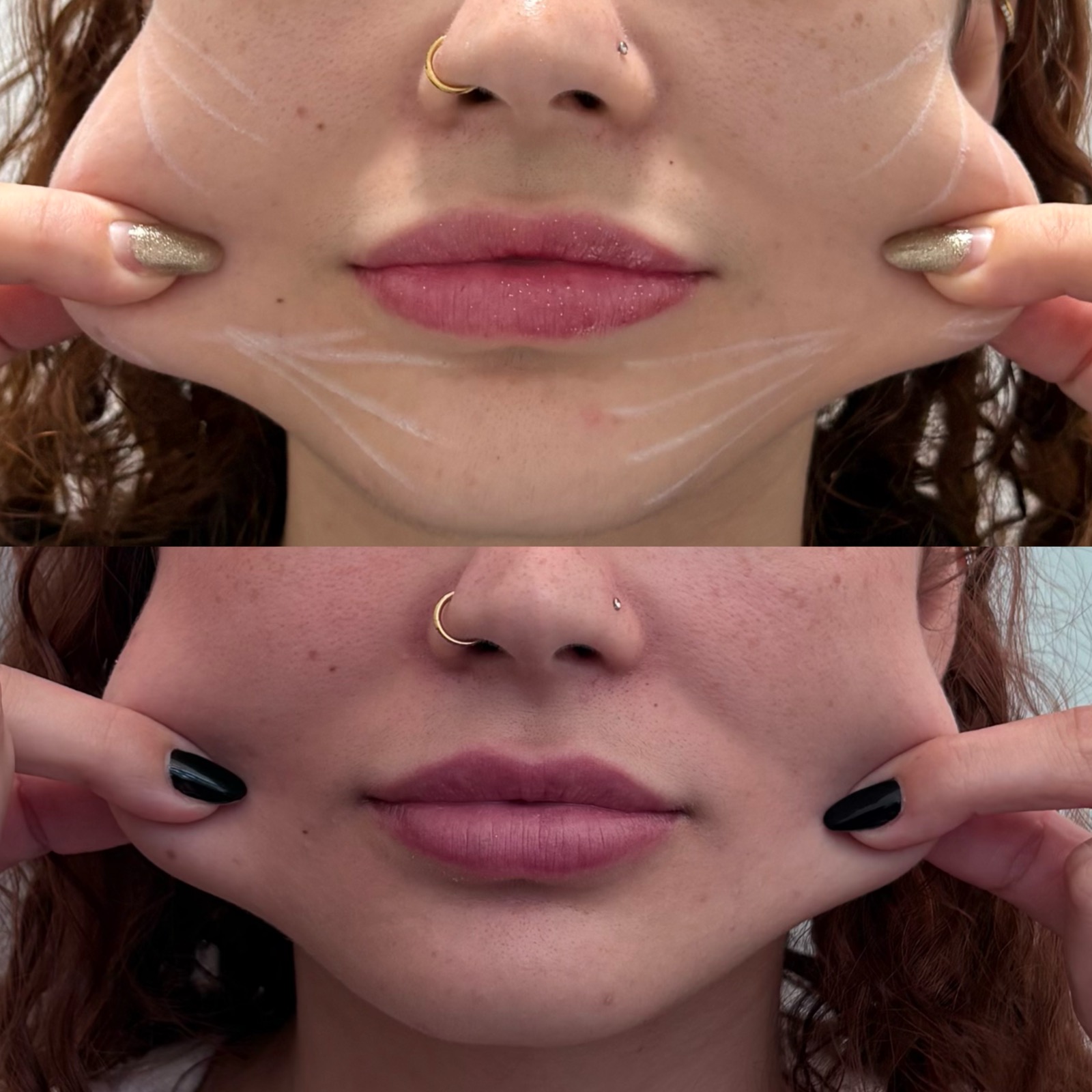 Evolução real do resultado com bioestimulador de colágeno
