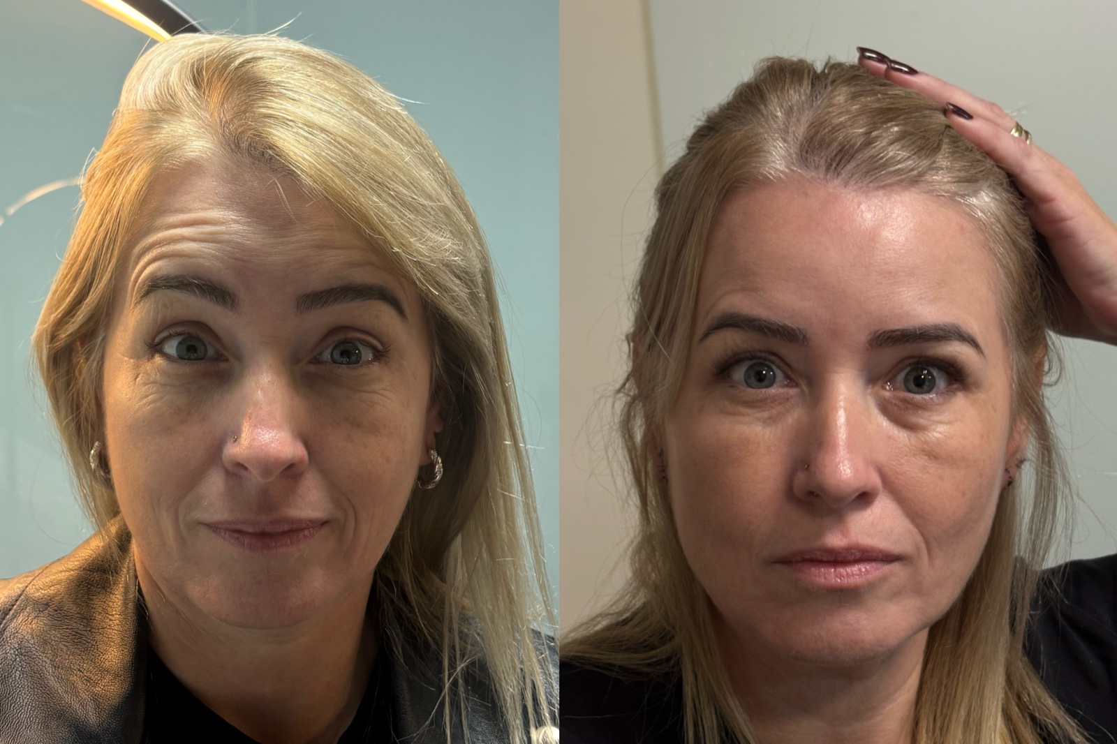 Antes e depois real de botox