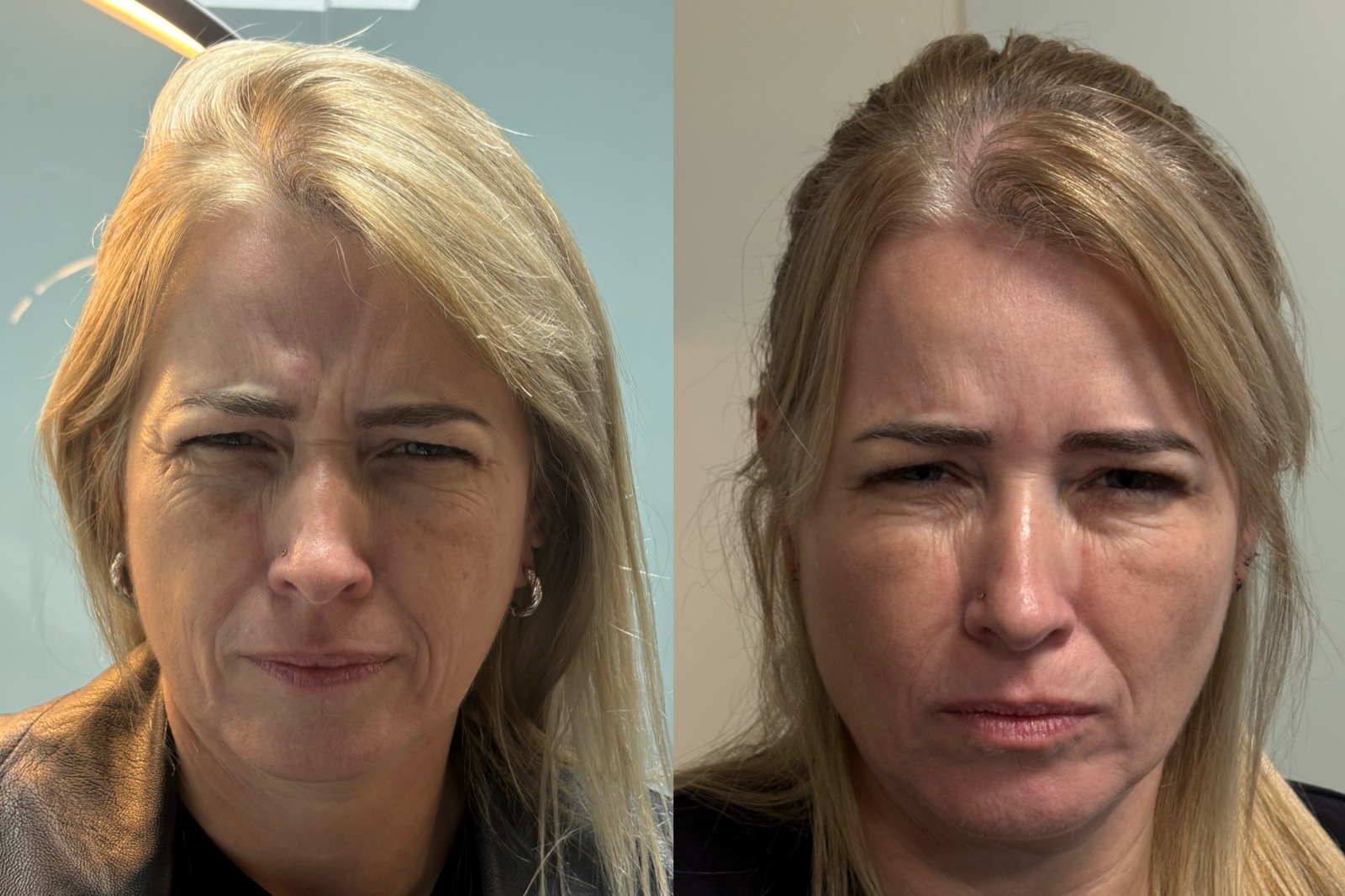 Antes e depois real de botox