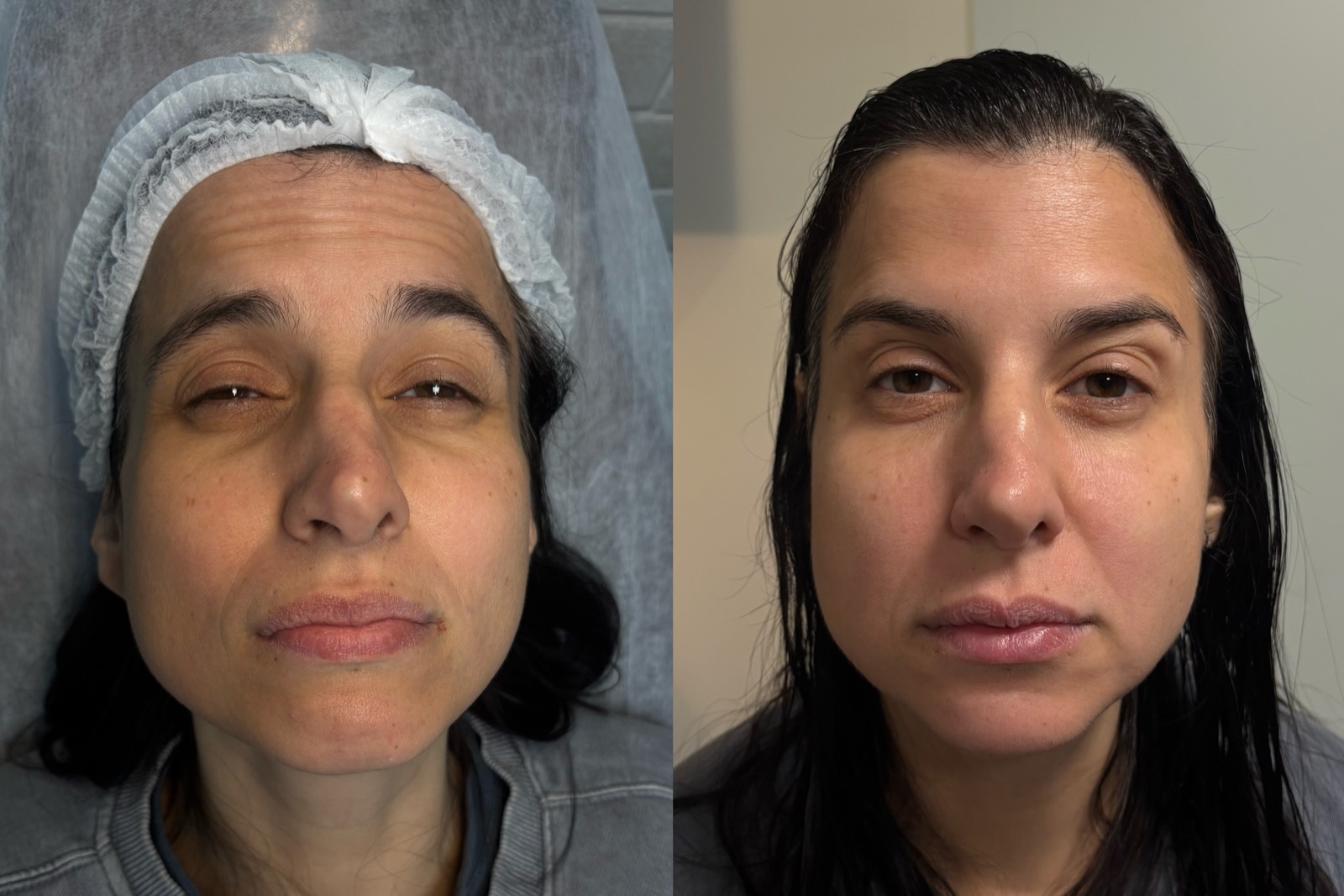 Antes e depois real de botox