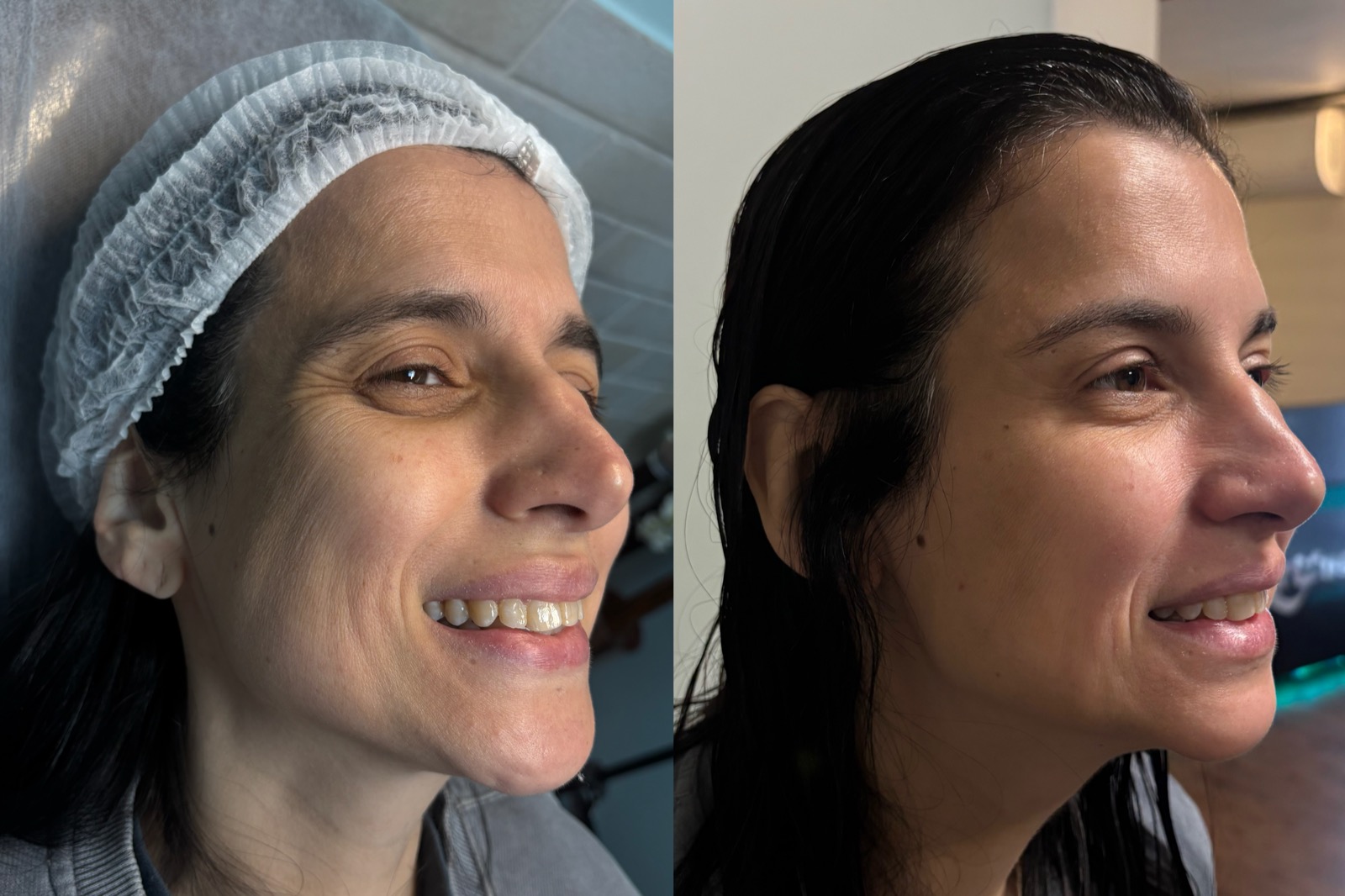 Antes e depois real de botox