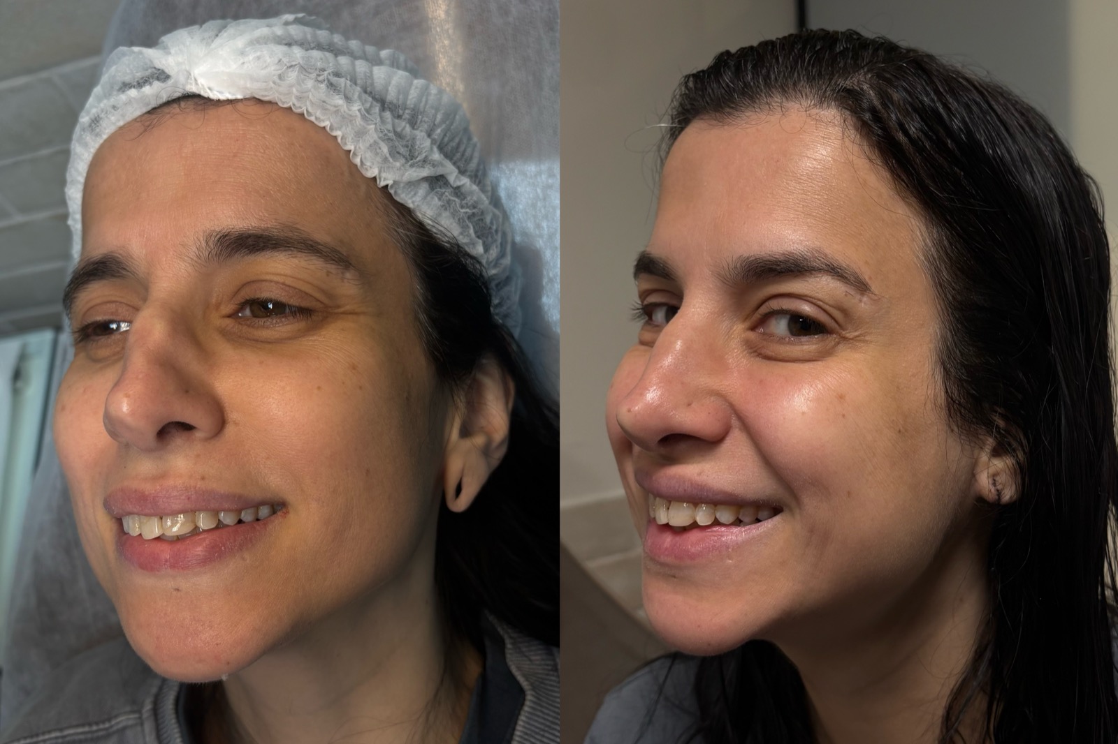 Antes e depois real de botox