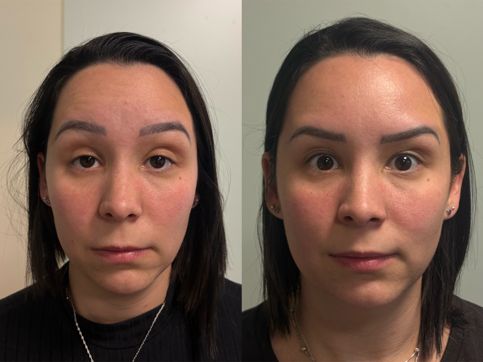 Antes e depois real de botox