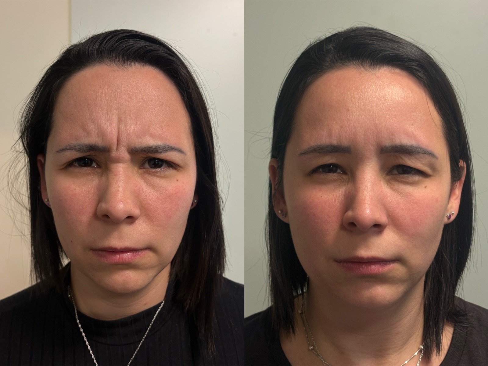 Antes e depois real de botox