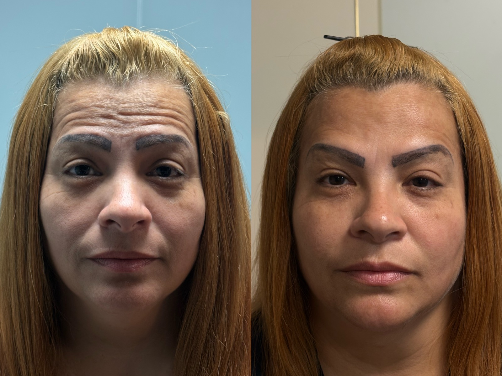 Antes e depois real de botox