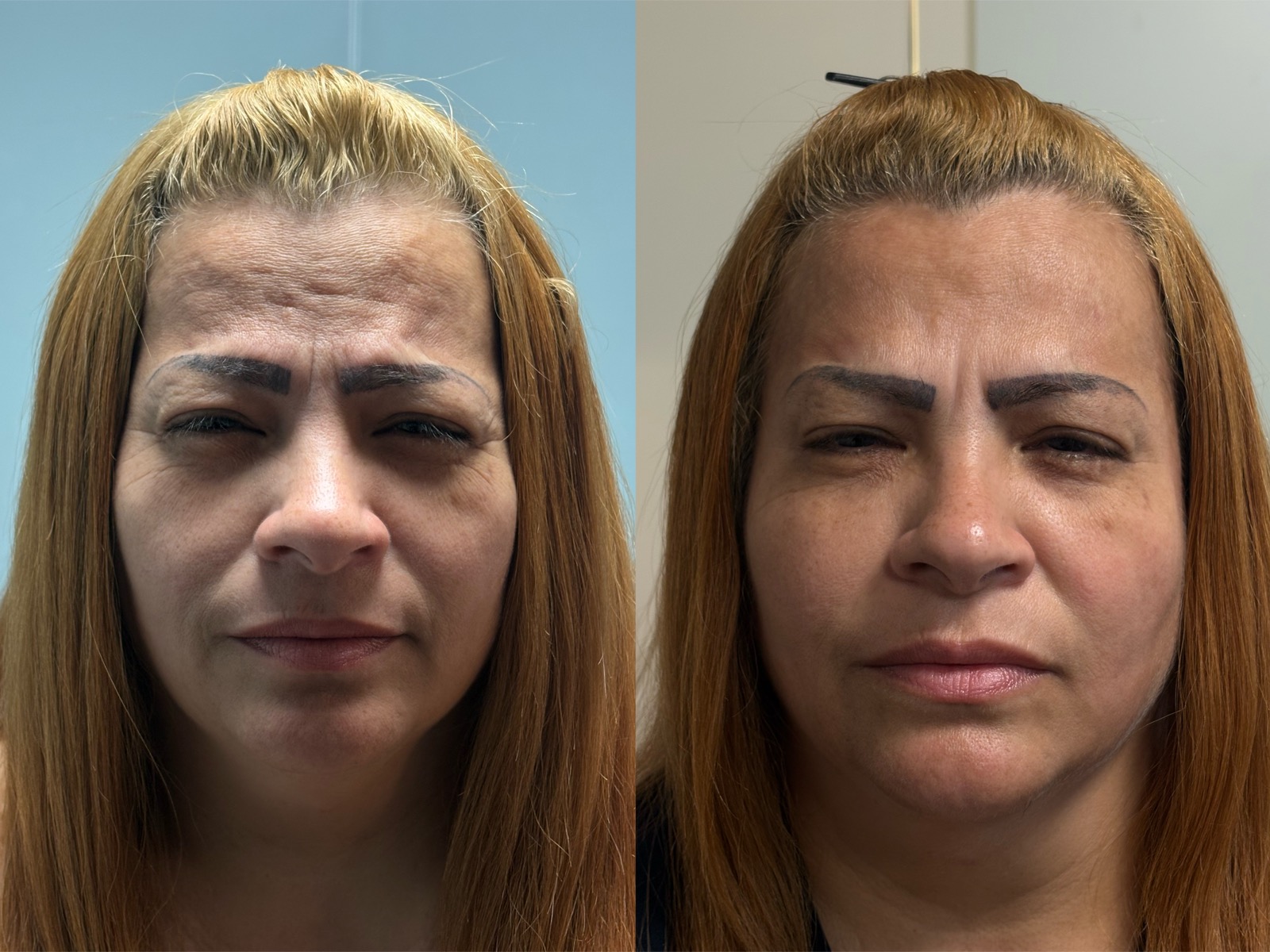 Antes e depois real de botox