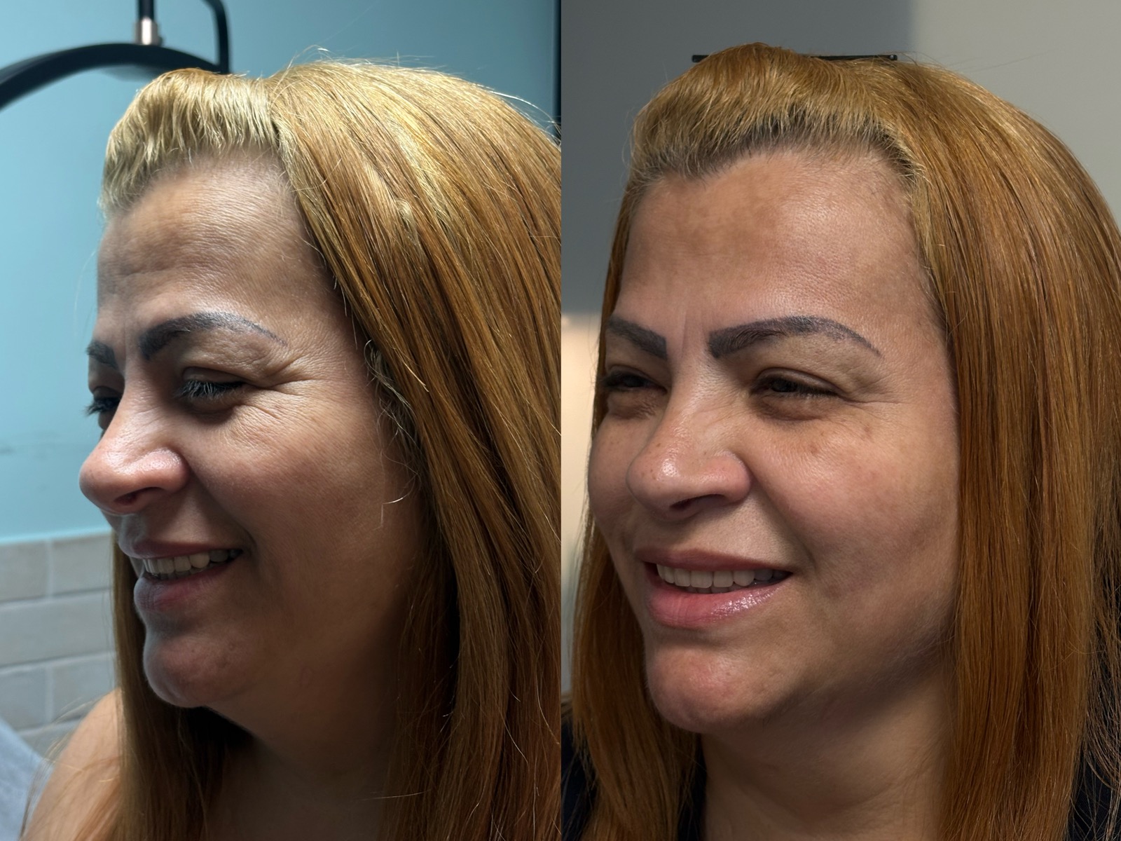 Antes e depois real de botox