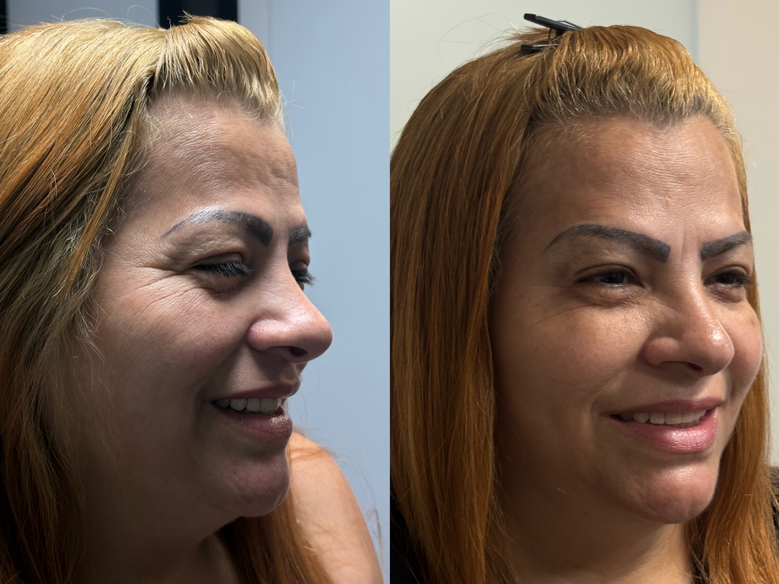 Antes e depois real de botox