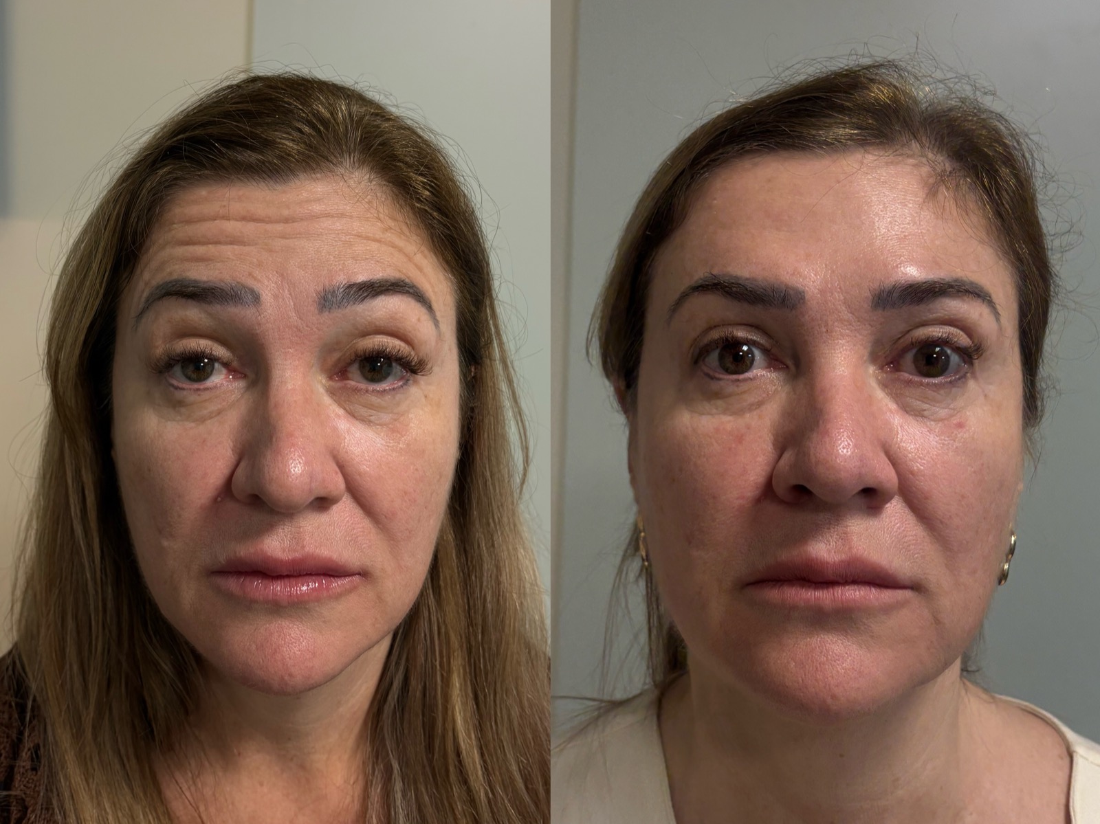 Antes e depois real de botox