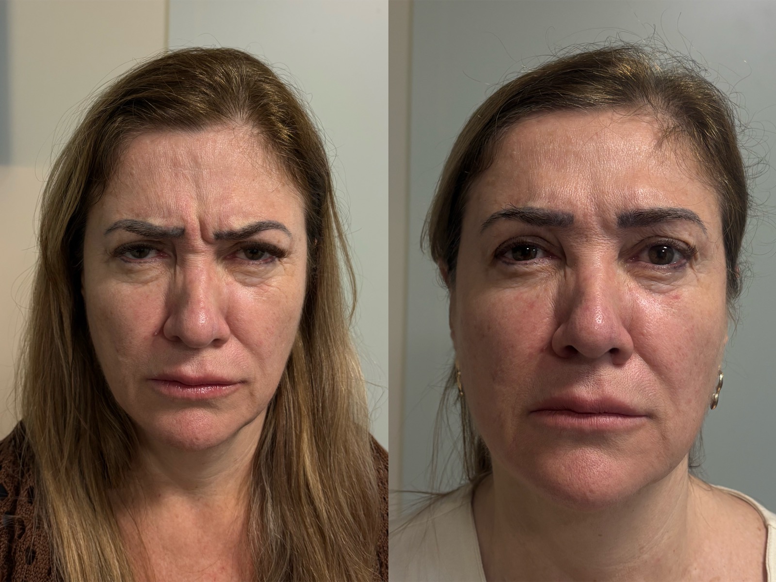 Antes e depois real de botox