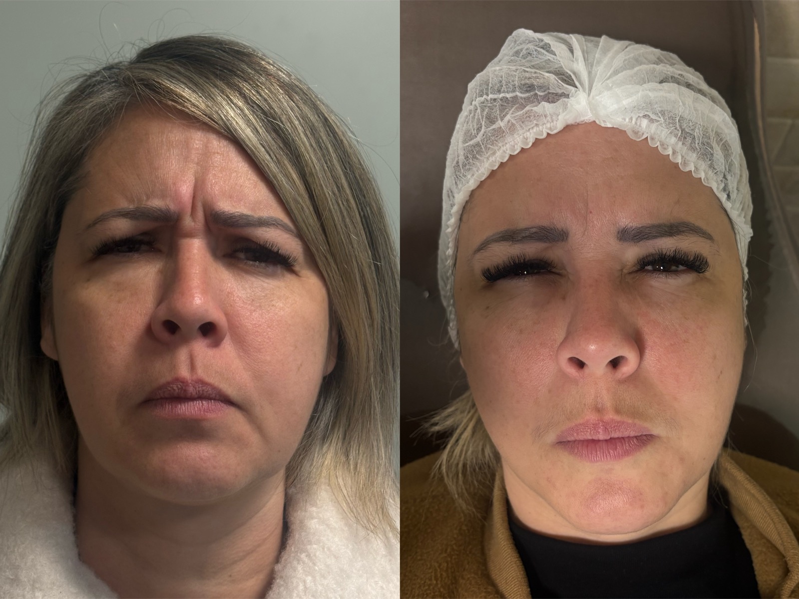 Antes e depois real de botox