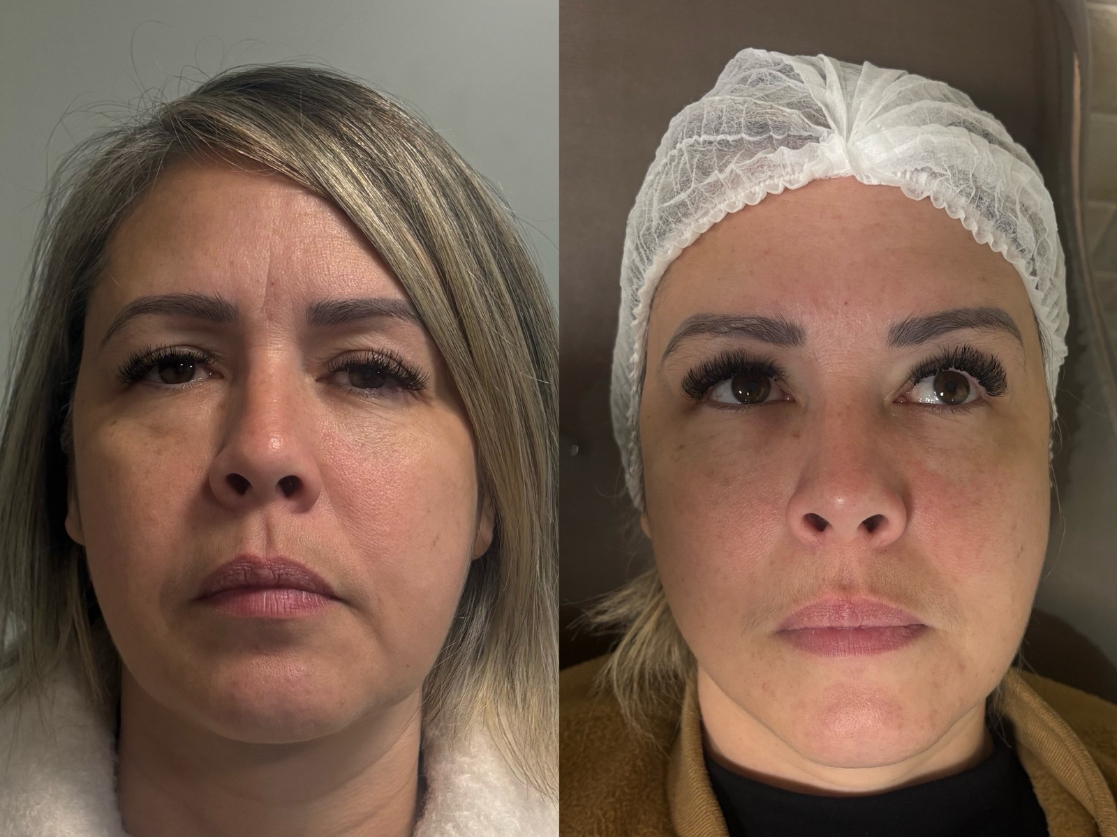 Antes e depois real de botox