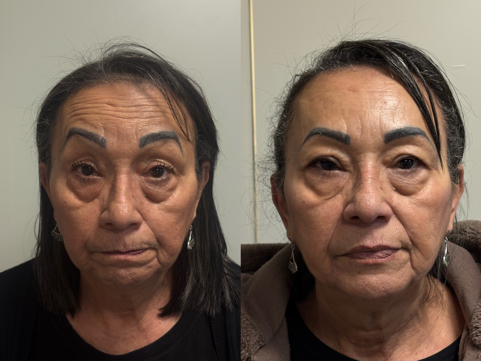 Antes e depois real de botox