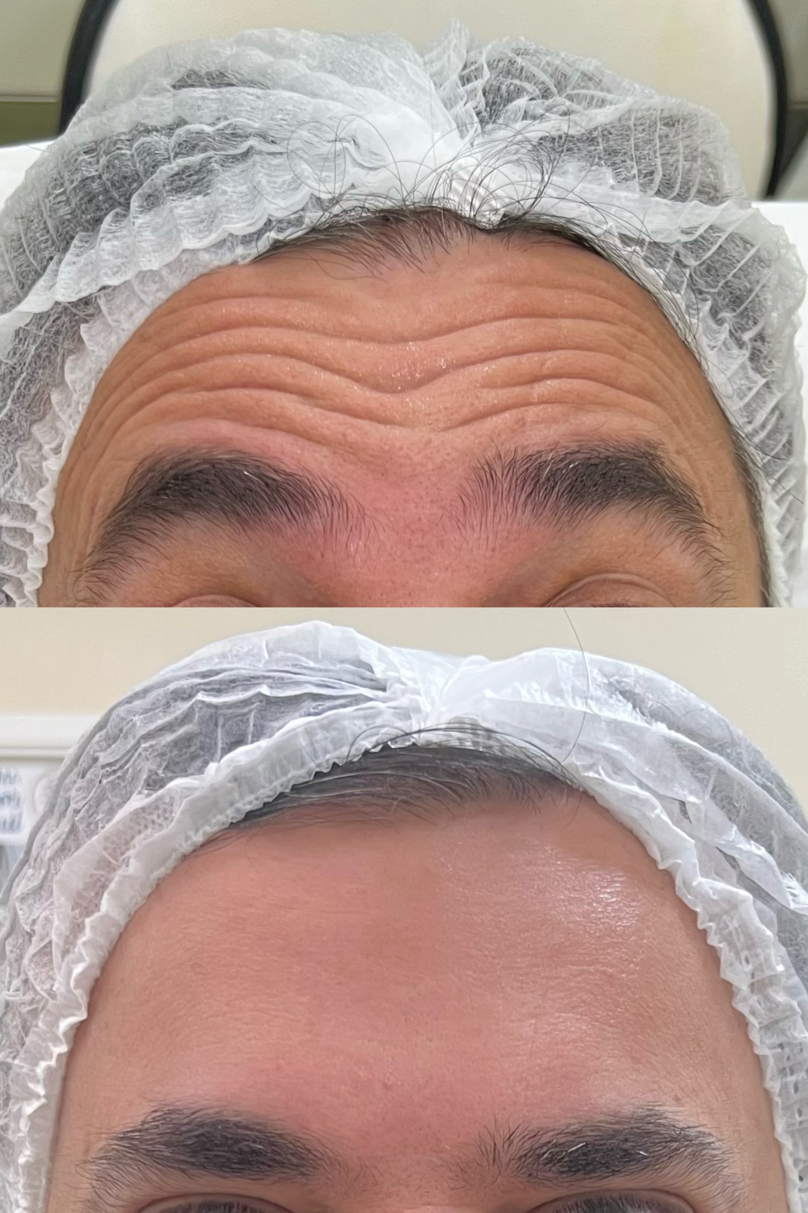 Antes e depois real de botox
