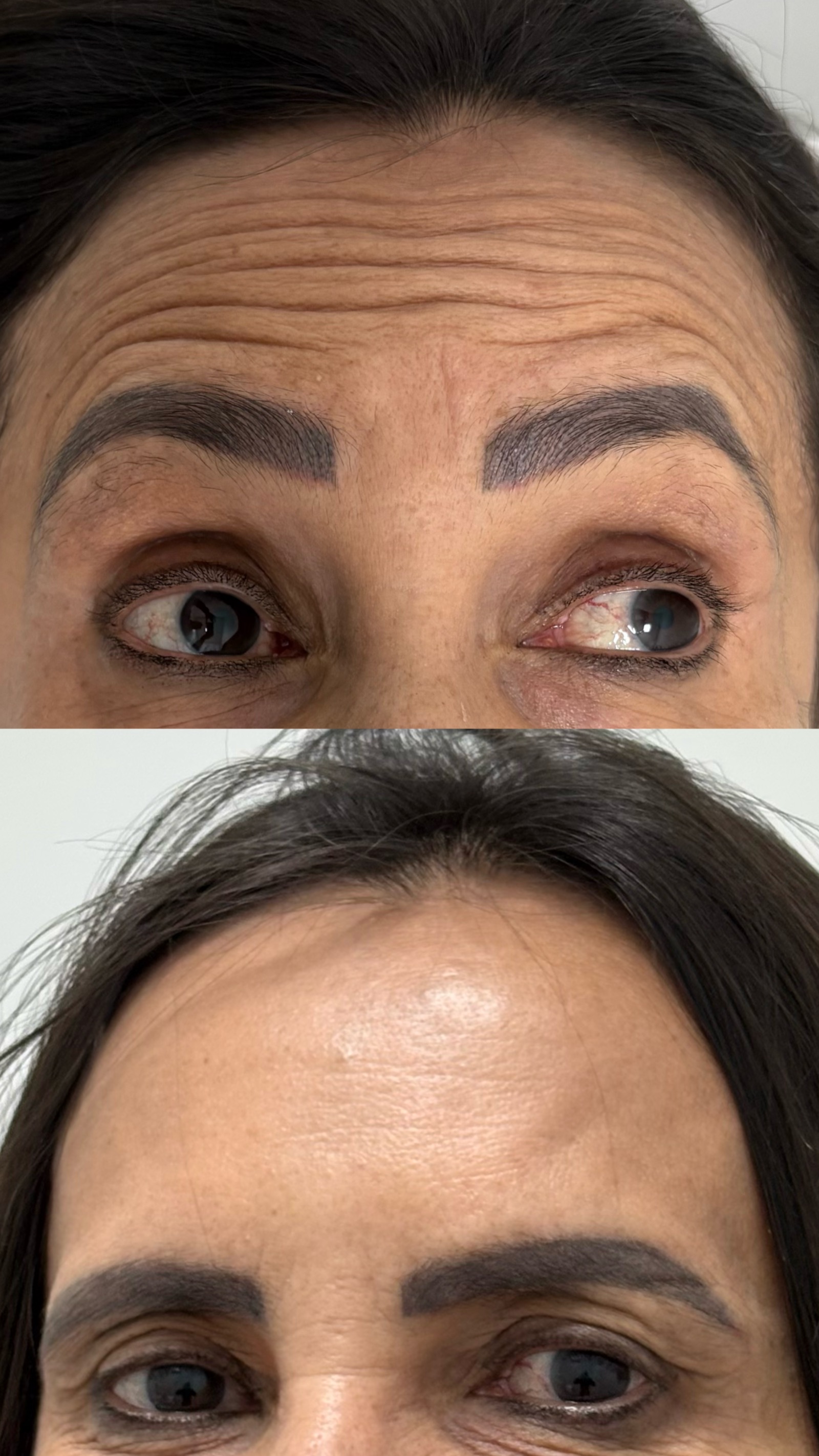 Antes e depois real de botox
