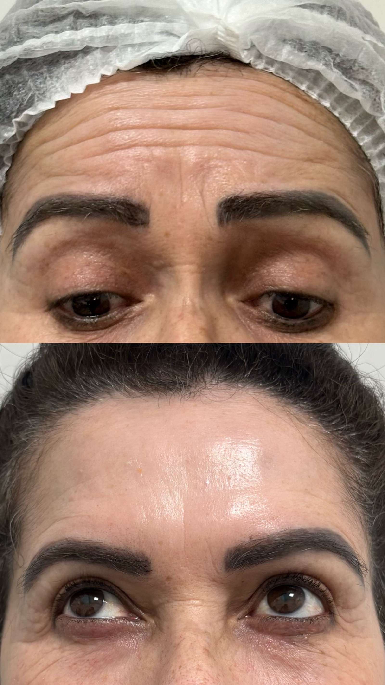 Antes e depois real de botox