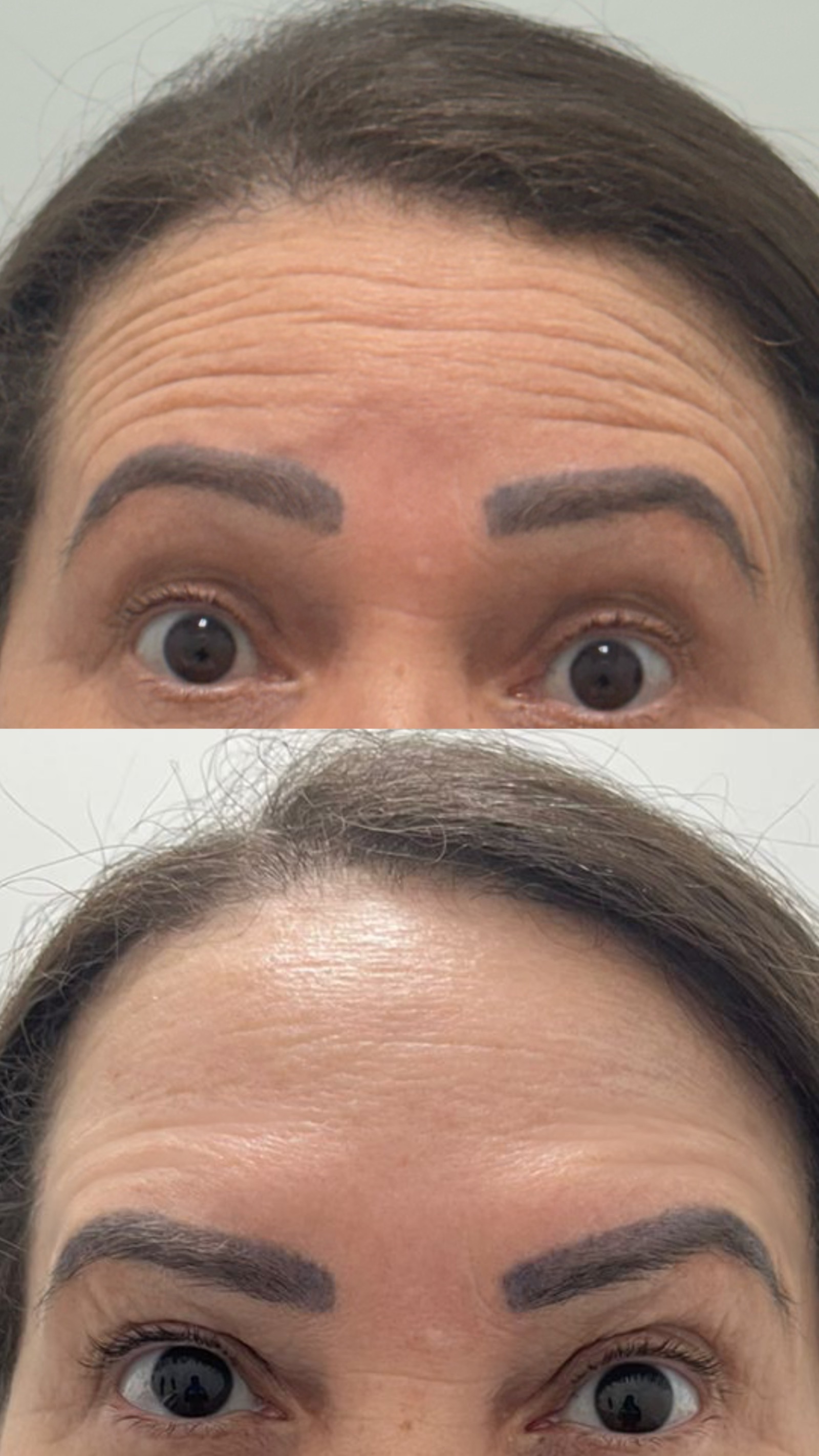 Antes e depois real de botox