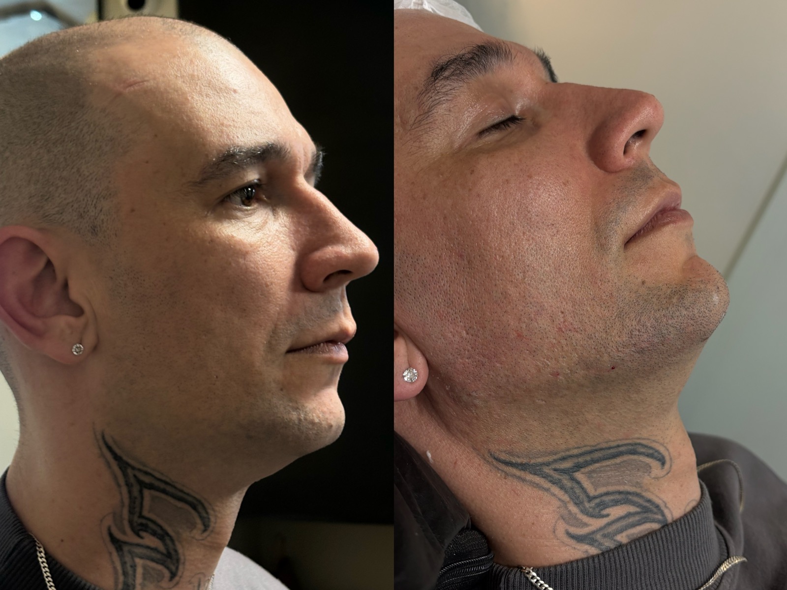 Antes e depois real de preenchimento facial