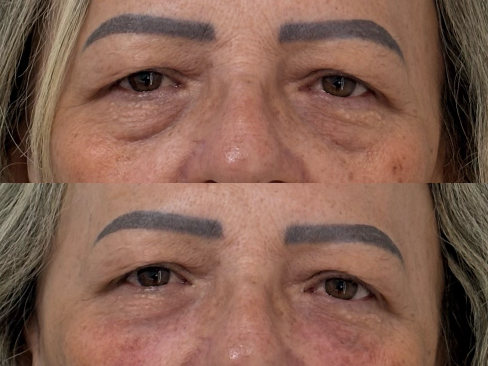Antes e depois real de preenchimento facial