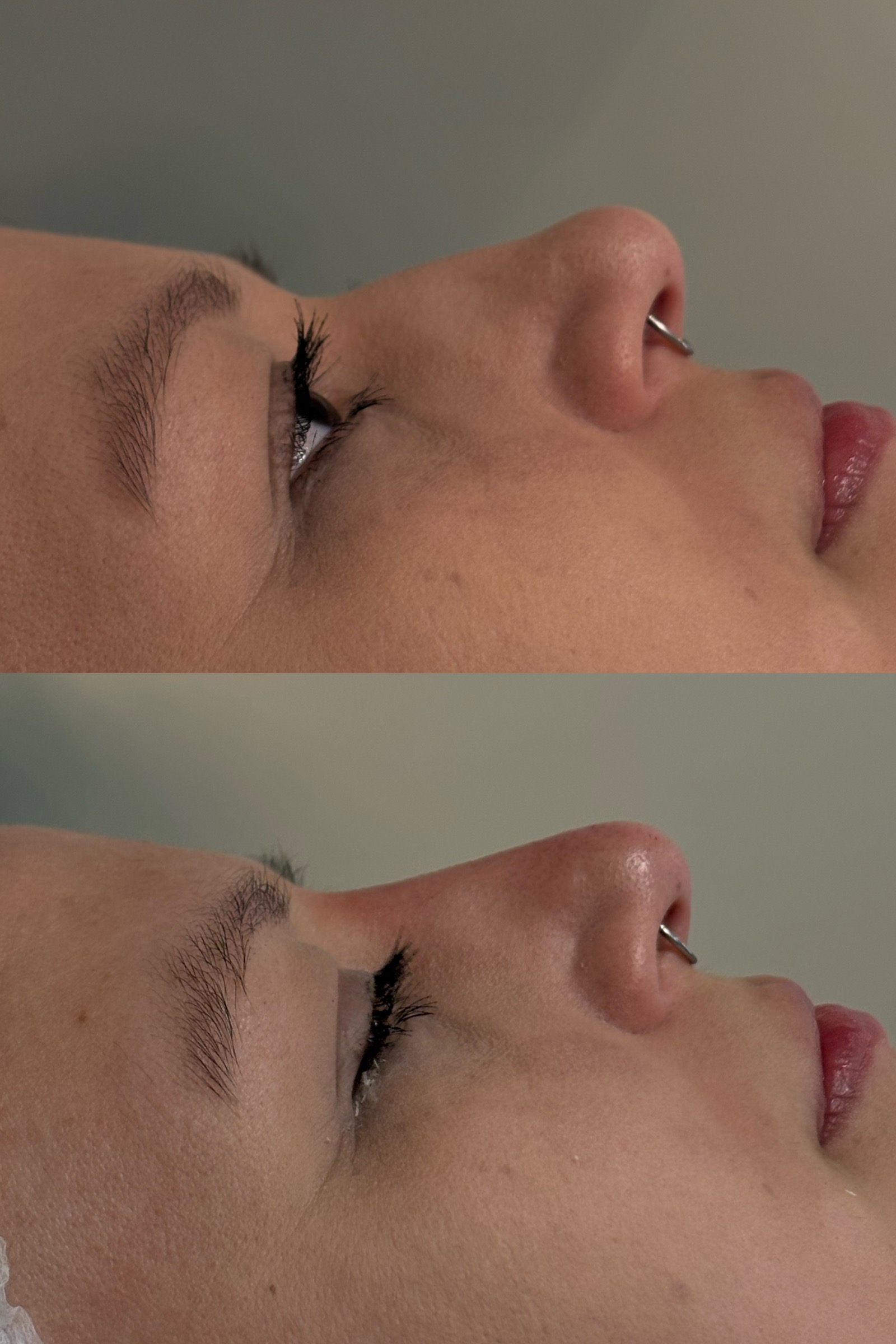 Antes e depois real de preenchimento facial