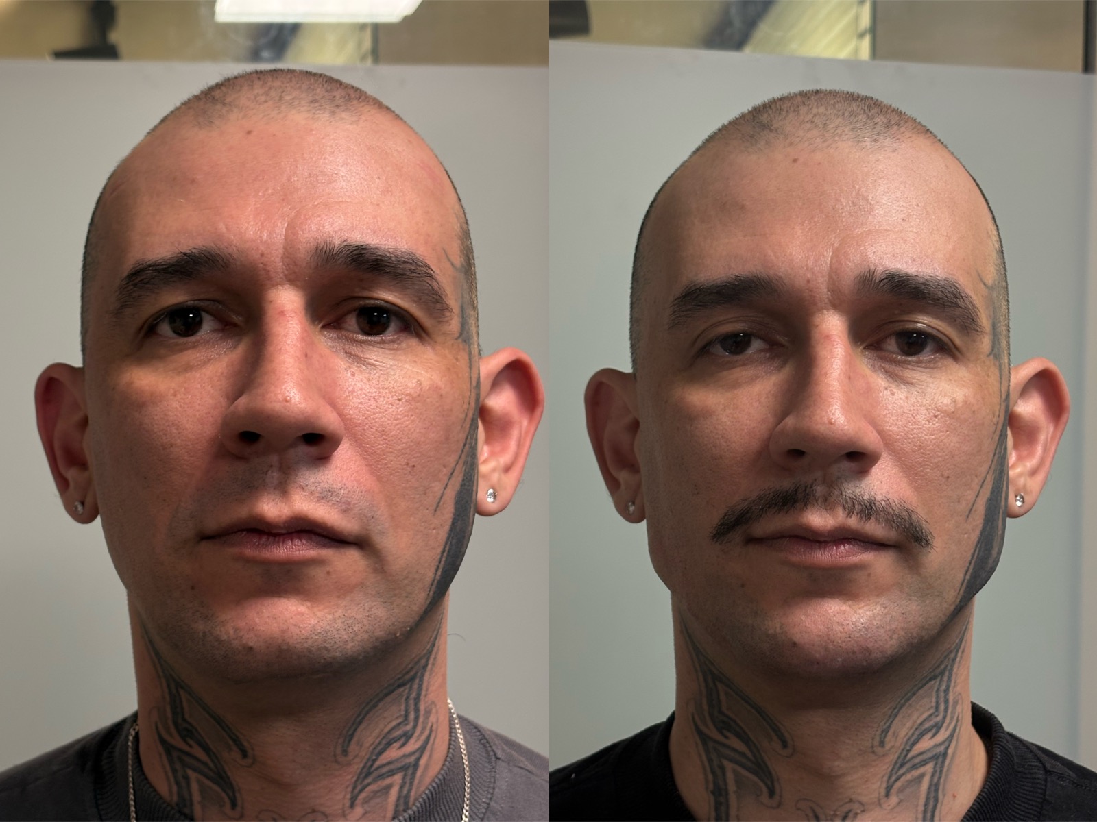 Antes e depois real de preenchimento facial