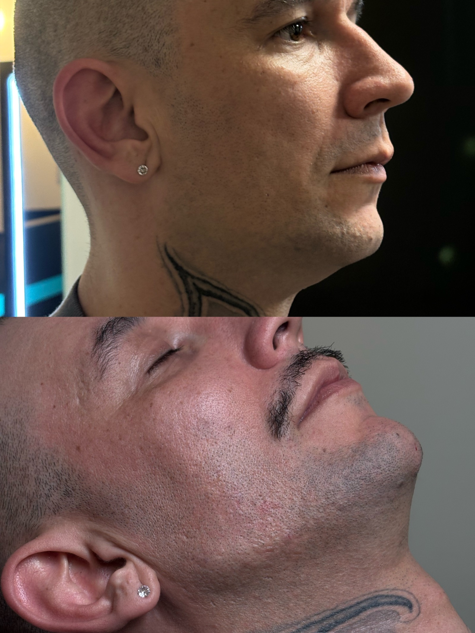 Antes e depois real de preenchimento facial