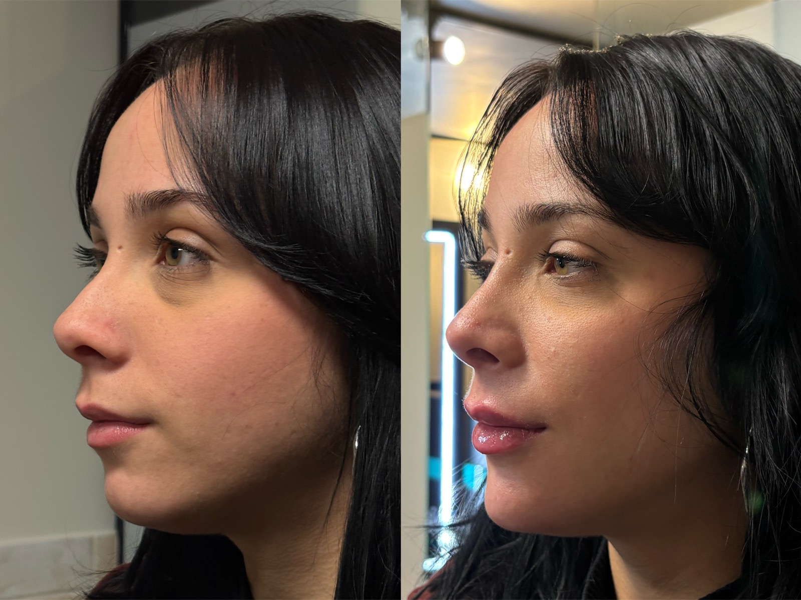 Antes e depois real de preenchimento facial