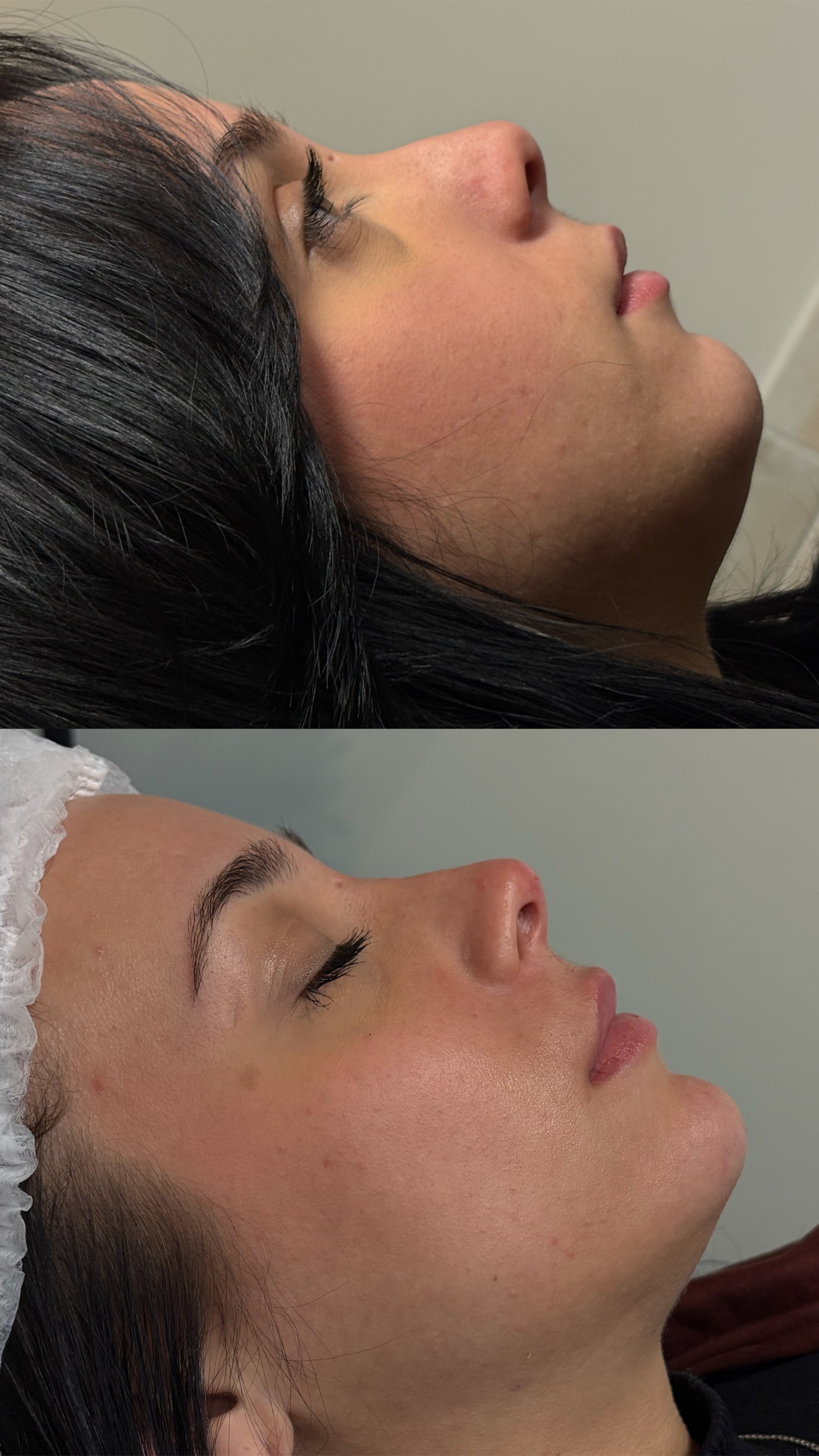 Antes e depois real de preenchimento facial