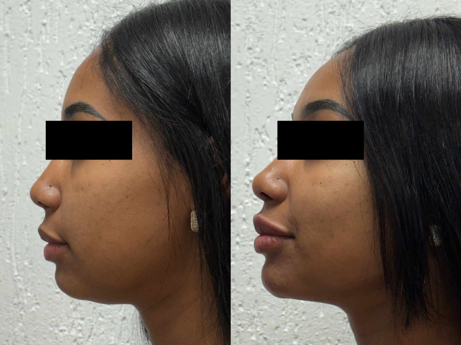 Antes e depois real de preenchimento facial