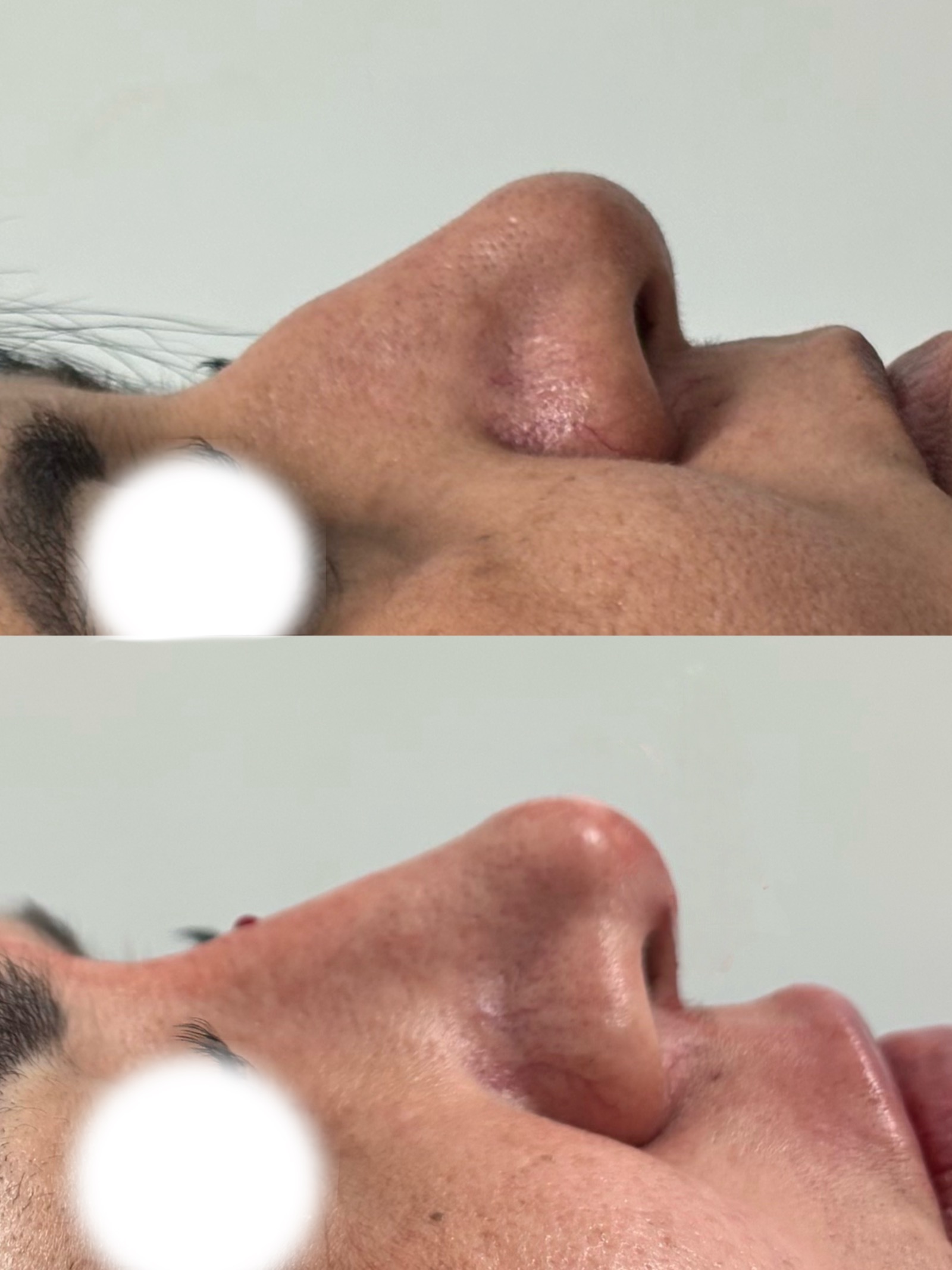 Antes e depois real de preenchimento facial