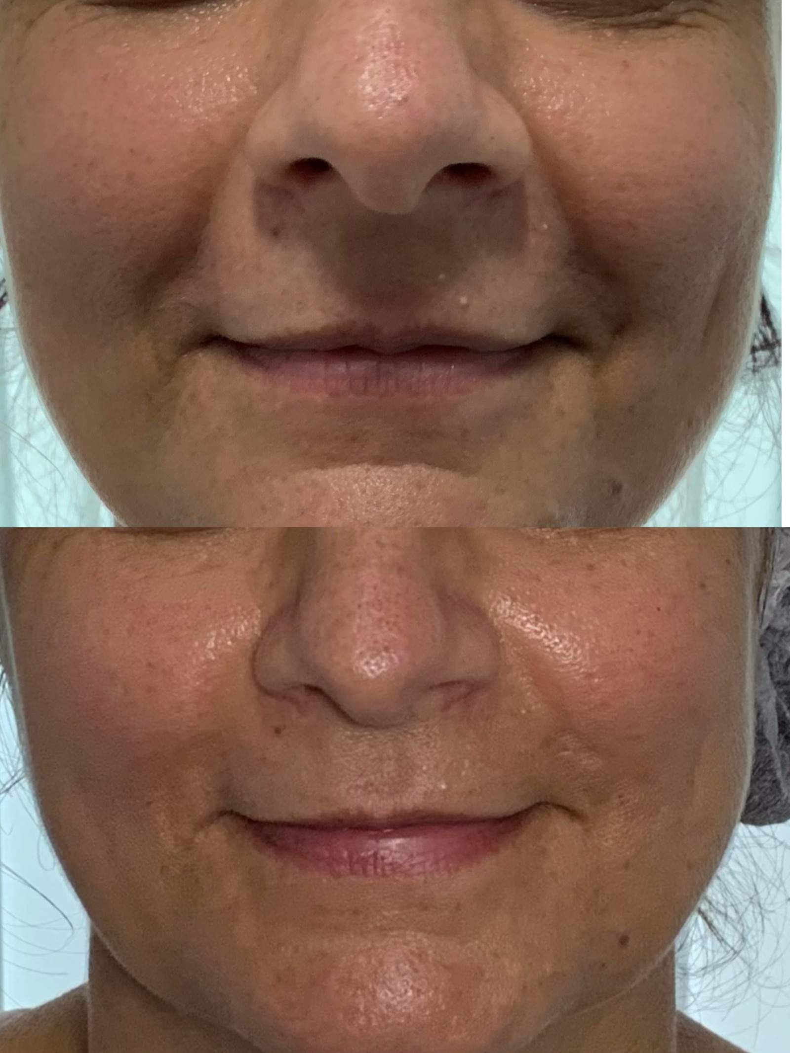 Antes e depois real de preenchimento facial