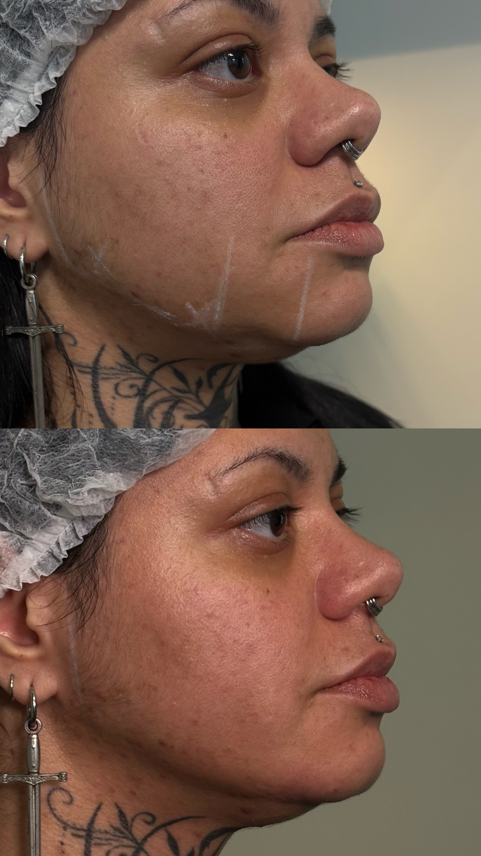 Antes e depois real de preenchimento facial
