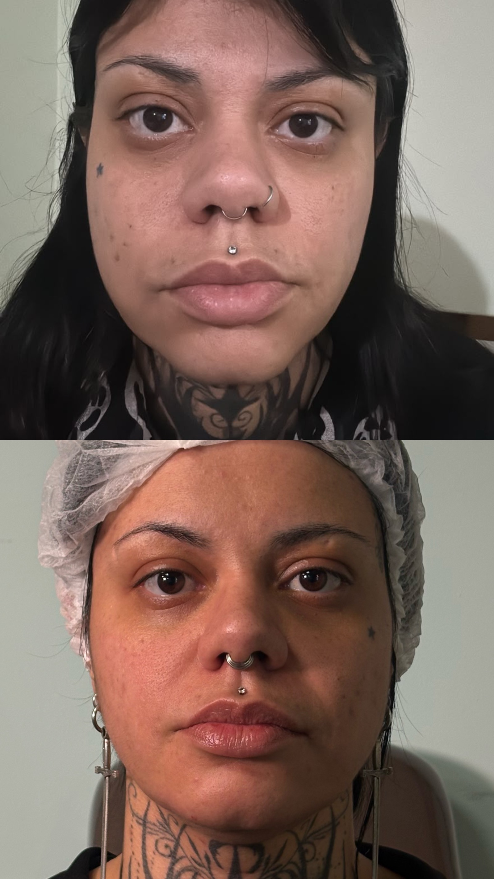 Antes e depois real de preenchimento facial